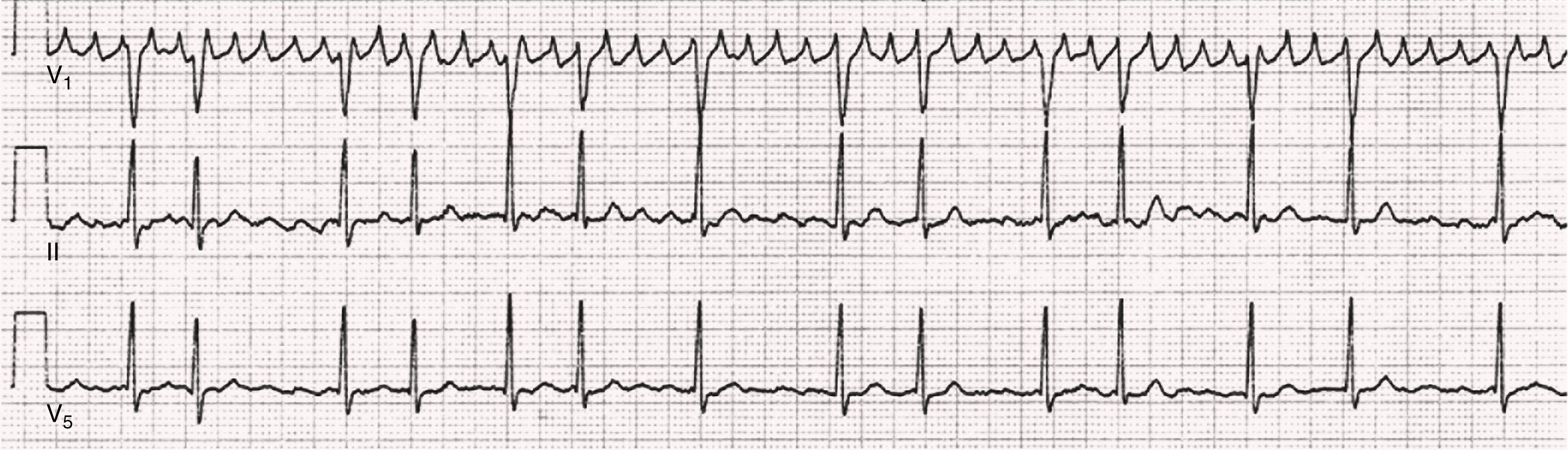 FIGURE 66.2, An example of AF with prominent f waves in V 1 that mimic atrial flutter waves. Note that typical f waves are present in leads II and V 5 , establishing the diagnosis of AF.