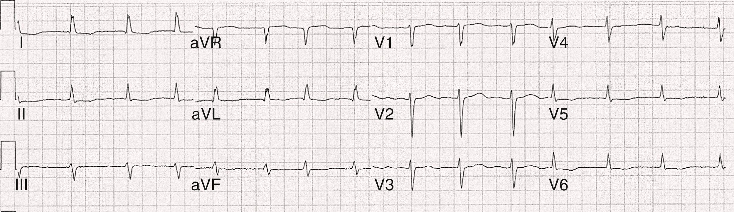 FIGURE 66.3, A 12-lead electrocardiogram of AF in which f waves are not discernible. The irregularly irregular ventricular rate indicates that this is AF.