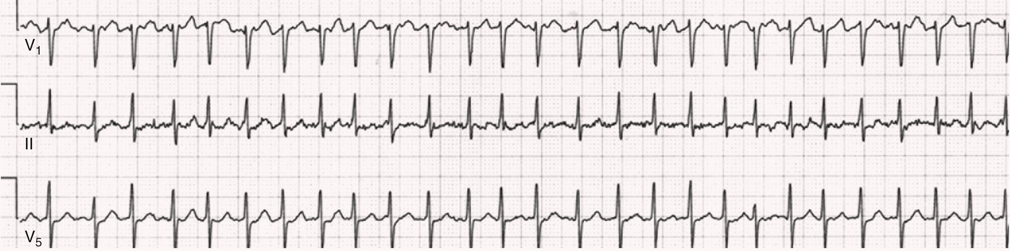 FIGURE 66.4, A recording of AF with a rapid ventricular rate of 160 beats/min. Shown are leads V 1 , II, and V 5 . On quick review, there may appear to be a regular rate consistent with paroxysmal supraventricular tachycardia. On closer inspection, it is clear that the rate is irregularly irregular.