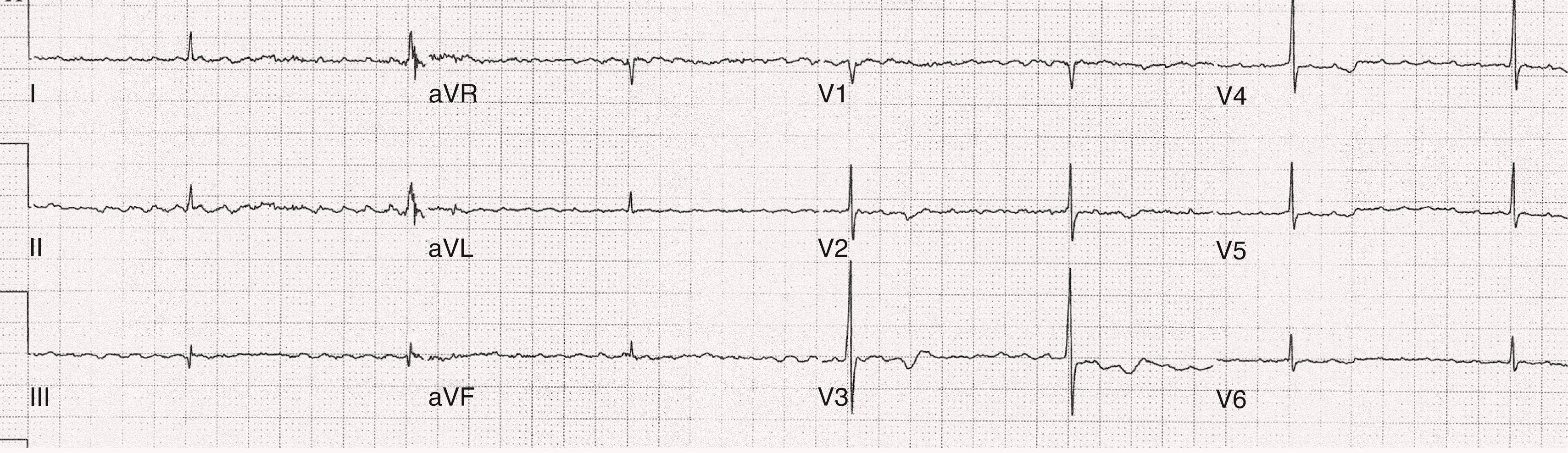 FIGURE 66.5, A 12-lead electrocardiogram of AF and a regular junctional rhythm at a rate of 43 beats/min. There is either underlying third-degree AV block or second-degree AV block with extremely slow atrioventricular conduction allowing a junctional escape rhythm to become manifest.