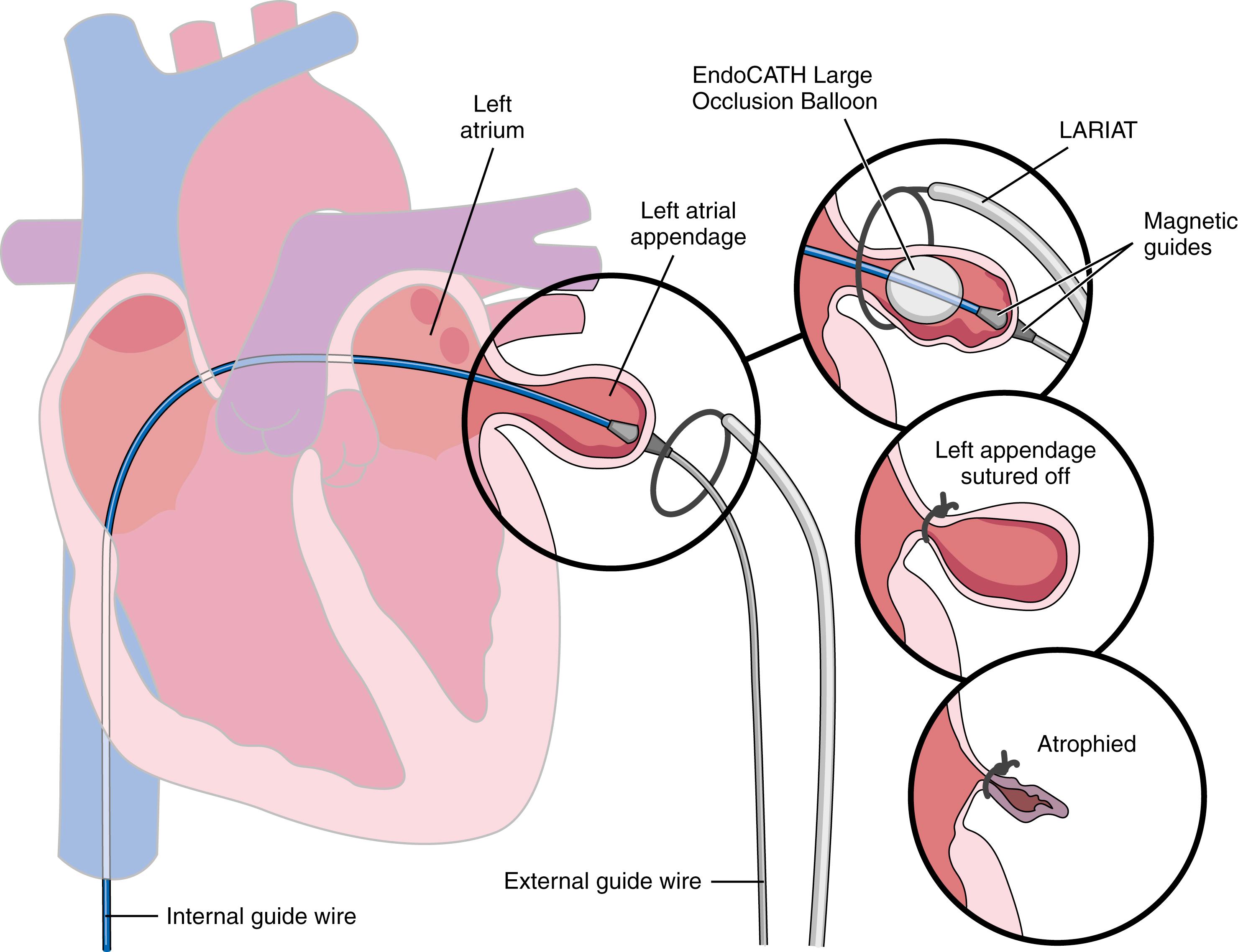 FIGURE 66.8, Steps involved in deploying the LARIAT catheter for occlusion of the left atrial appendage.