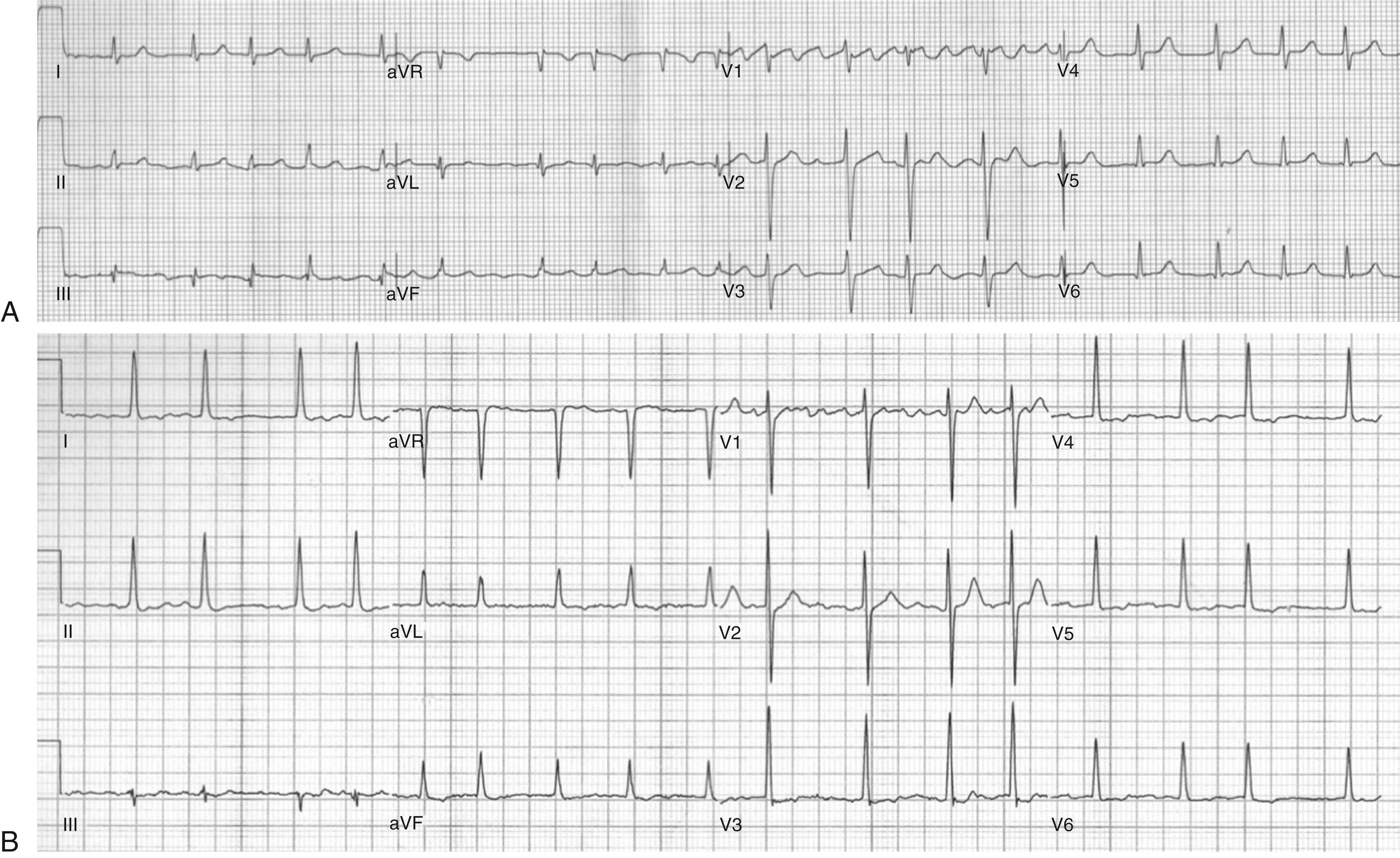 Fig. 75.2, Electrocardiographic types of atrial fibrillation (AF).