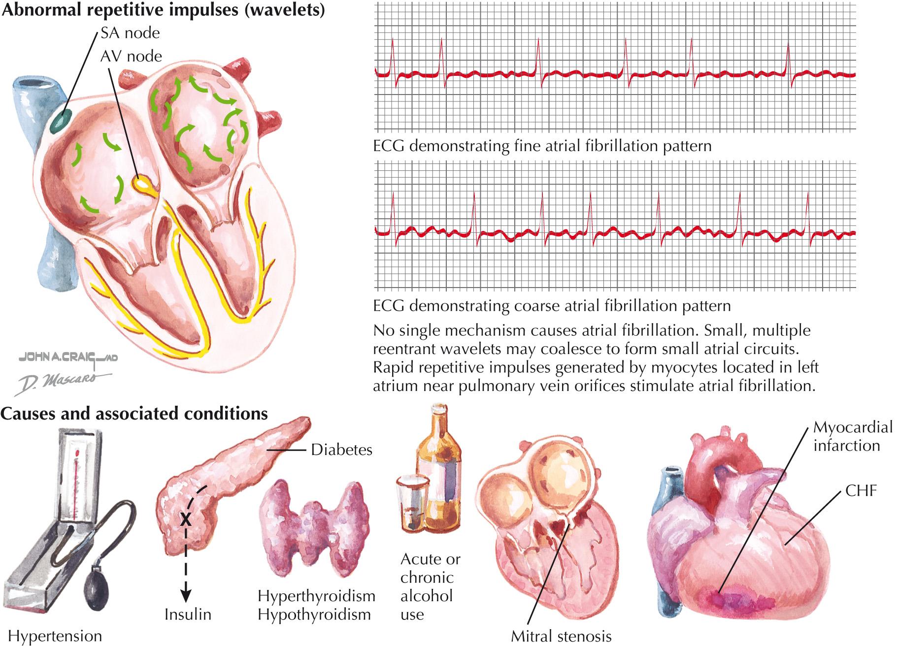 FIG 38.1, Pathogenesis of Atrial Fibrillation.