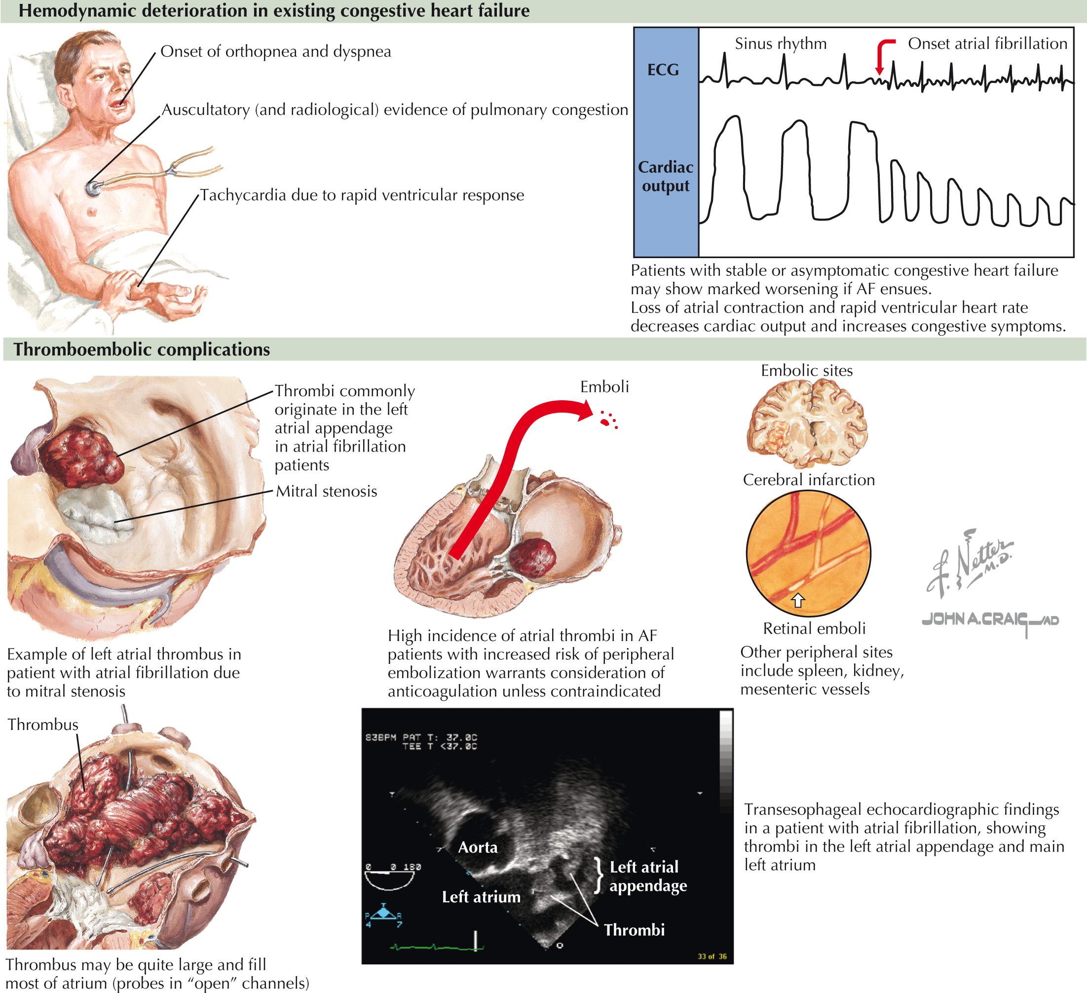 FIG 38.2, Clinical Presentation of Atrial Fibrillation.