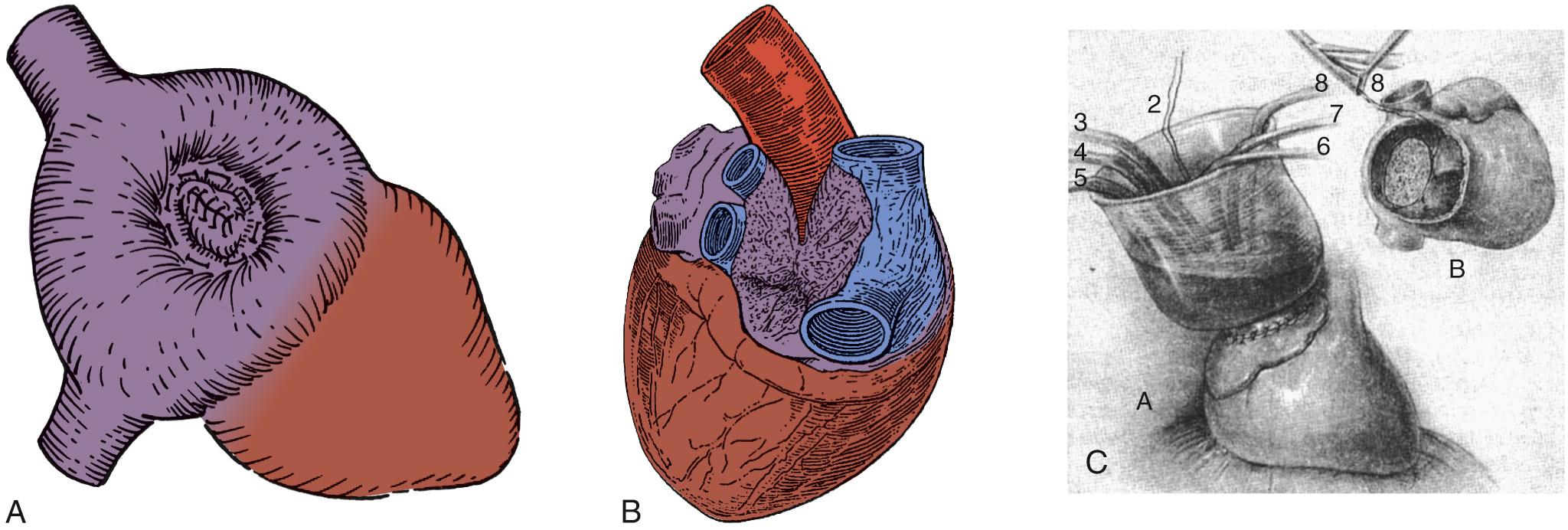 FIGURE 114-1, Techniques for surgical atrial septal defect closure predating cardiopulmonary bypass. A, Atrio-septo-pexy. B, External purse-string suture closure. C, Atrial well technique.