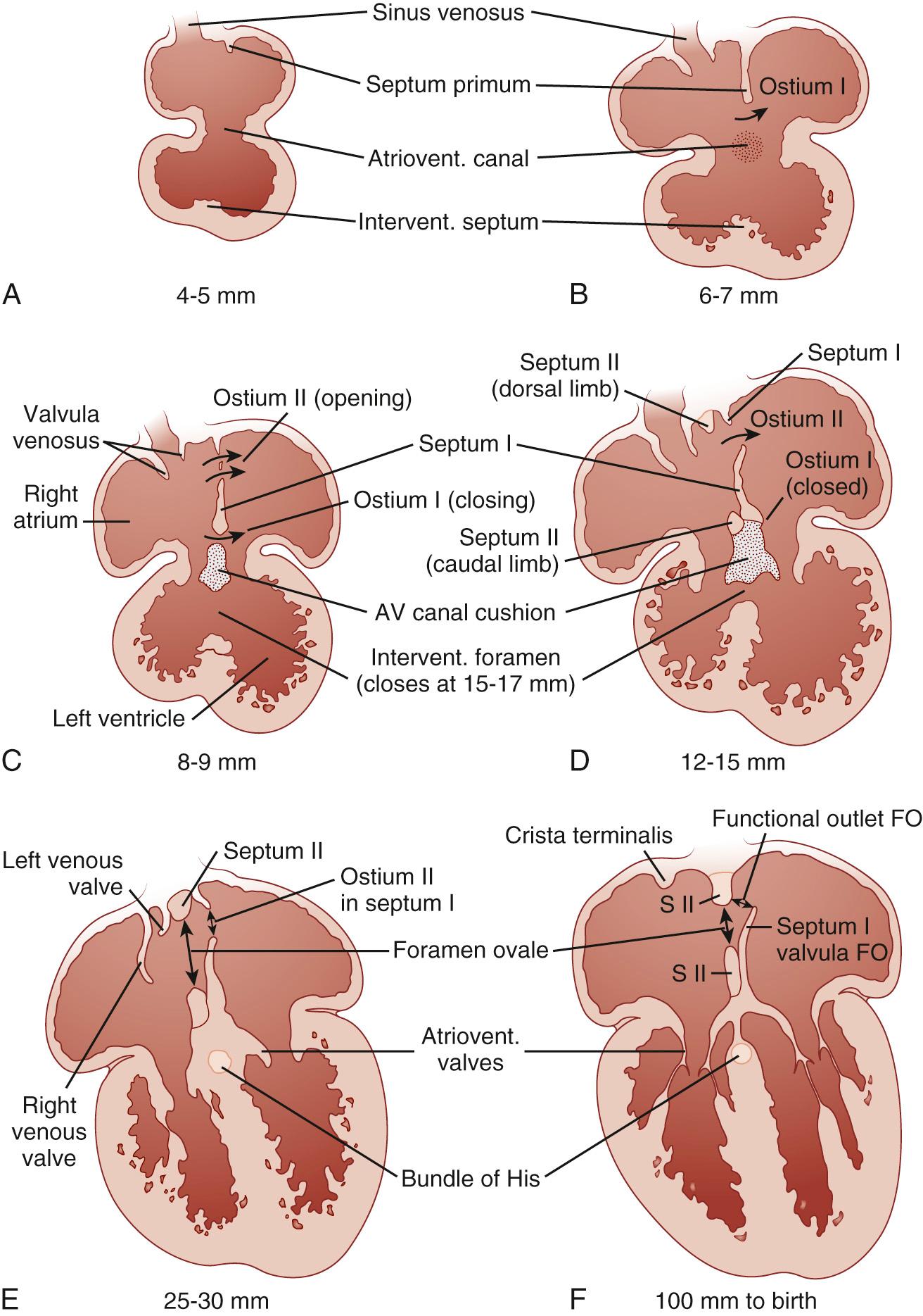 FIGURE 114-2, Four-chamber sectional diagrams of the fetal heart with particular attention to the morphology of the forming interatrial septum and the foramen ovale. A, The early stages in the formation of the septum primum, from the superior aspect of the common atrium. B, As the septum primum grows toward the endocardial cushion, the ostium primum is defined. C, As the ostium primum closes, the ostium secundum forms by the resorption of the cephalad portions of the septum primum. D, The septum secundum begins to form rightward and parallel to the septum primum, obliterating the remaining ostium primum. E and F, The septum secundum circumscribes the foramen ovale, and the septum primum creates a flap valve permitting only right-to-left flow. AV, Atrioventricular; FO, foramen ovale.
