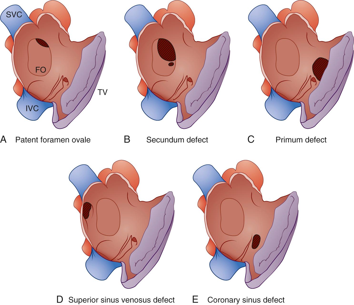 FIGURE 114-3, The morphologic classification of atrial septal defects. A, Patent foramen ovale. B, Secundum atrial septal defect. C, Primum atrial septal defect. D, Superior sinus venosus defect. E, Coronary sinus interatrial defect. FO, Foramen ovale; IVC, inferior vena cava; SVC, superior vena cava; TV, tricuspid valve.