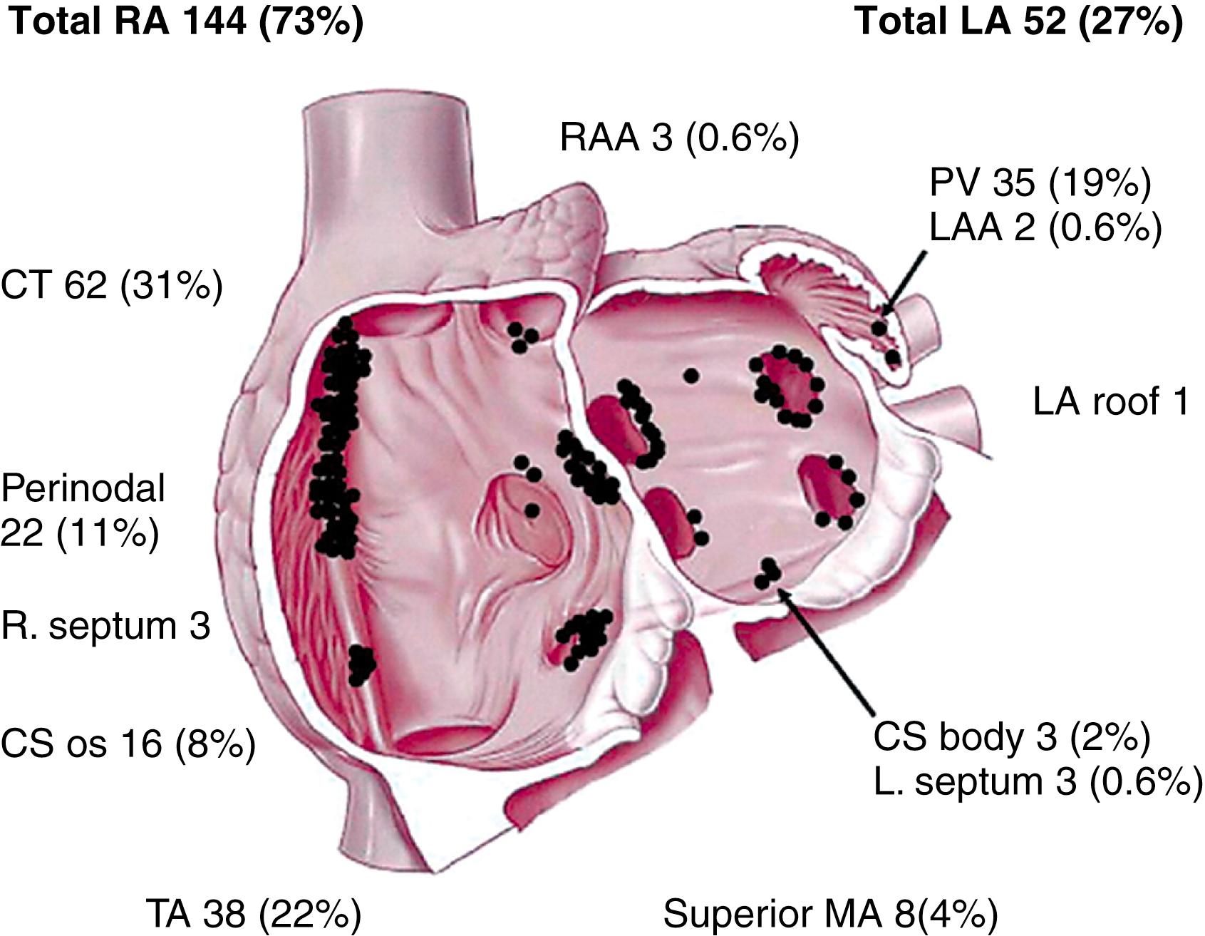 Fig. 71.2, Schematic representation of the anatomic distribution of focal atrial tachycardias.