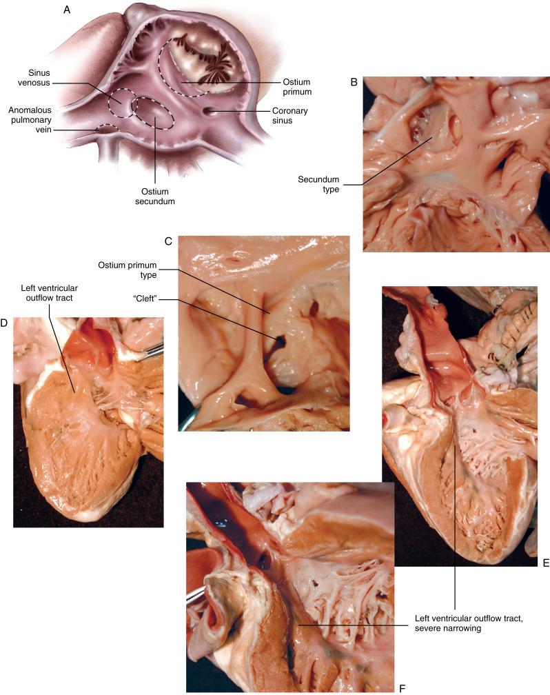 Figure 4-1, A There are three main types of atrial septal defects. The most common is the secundum type, in which the defect occupies the location of the foramen ovale. The ostium primum type is actually a defect of the atrioventricular septum and is located low in the septum. The defect is crescent-shaped and is associated with atrioventricular valve abnormalities. The sinus venosus type of atrial septal defect is located high in the septum, near the superior vena cava orifice, and is often associated with an anomalous connection of the right superior pulmonary vein. B Atrial septal defect, secundum type. The ostium secundum defect is an embryologic failure of atrial septation related to excessive fenestration of the septum primum during formation of the ostium secundum or inadequate coverage of the ostium secundum by the septum secundum as it descends from the roof of the atrium. This specimen shows some features of both mechanisms: there are fenestrations extending inferiorly to the limbus of the fossa ovalis, and the atrial septum is clearly thicker in the fossa above the fenestrations. There is also a patent foramen ovale due to failure of fusion after birth. Thus, there are two defects within the fossa ovalis, both some distance above the annulus of the tricuspid valve. C Atrial septal defect, ostium primum type. The term atrioventricular septal defect has been proposed to describe the group of defects variously termed endocardial cushion defects and atrioventricular canal defects . The pathognomonic feature of this group of malformations, whatever the specific type, is a defect at the site of the atrioventricular septum. The normal atrioventricular septum is composed of the fibrous extension of the central fibrous body, located at the junction of the aortic root and the atrioventricular valve rings, and a muscular portion that is the cephalic segment of the inlet ventricular septum. These defects also have a virtually identical common atrioventricular junction guarded by a basically six-leaflet common atrioventricular valve. It is the anatomy of these leaflets bridging the ventricular septum that differentiates the partial and complete forms of the defect. In the partial form of the anomaly, the bridging leaflets of the atrioventricular valve are joined by a connecting tongue of valve tissue and are usually firmly adherent to the crest of the ventricular septum. This specimen demonstrates an intact fossa ovalis with a small rim of septum that extends to the coronary sinus. The septal rim borders a low-lying atrial septal defect extending to the atrioventricular valves. This defect is caused by the embryologic failure of the septum primum to fuse with the endocardial cushions. The left atrioventricular valve shows a prominent “cleft” in its septal portion, but the valve is fused to the ventricular septum. D Atrioventricular septal defect, left ventricular outflow tract. The left ventricular outflow tract is abnormal in all patients with this defect. It is longer and narrower than normal because of the left atrioventricular valve’s attachment to the ventricular septum at the edge of the septal deficiency, which may or may not be an open defect. The extent of narrowing is determined by how far the septal deficiency extends across the septum below the aortic valve. In this case, the narrowing of the left ventricular outflow tract is moderate, extending only halfway across the diameter of the aortic orifice. E Atrioventricular septal defect, left ventricular outflow tract, severe narrowing. This specimen shows severe narrowing of the left ventricular outflow tract due to the left atrioventricular valve’s attachment to a large ventricular septal deficiency that involves most of the septum below the aortic valve. Note that there is no opening in the ventricular septum due to dense atrioventricular valve tissue occluding the septum. F Atrioventricular septal defect, left ventricular outflow tract, severe narrowing. This specimen illustrates a steeper angle than that in Figure 4-1 , E , with severe narrowing of the left ventricular outflow tract.