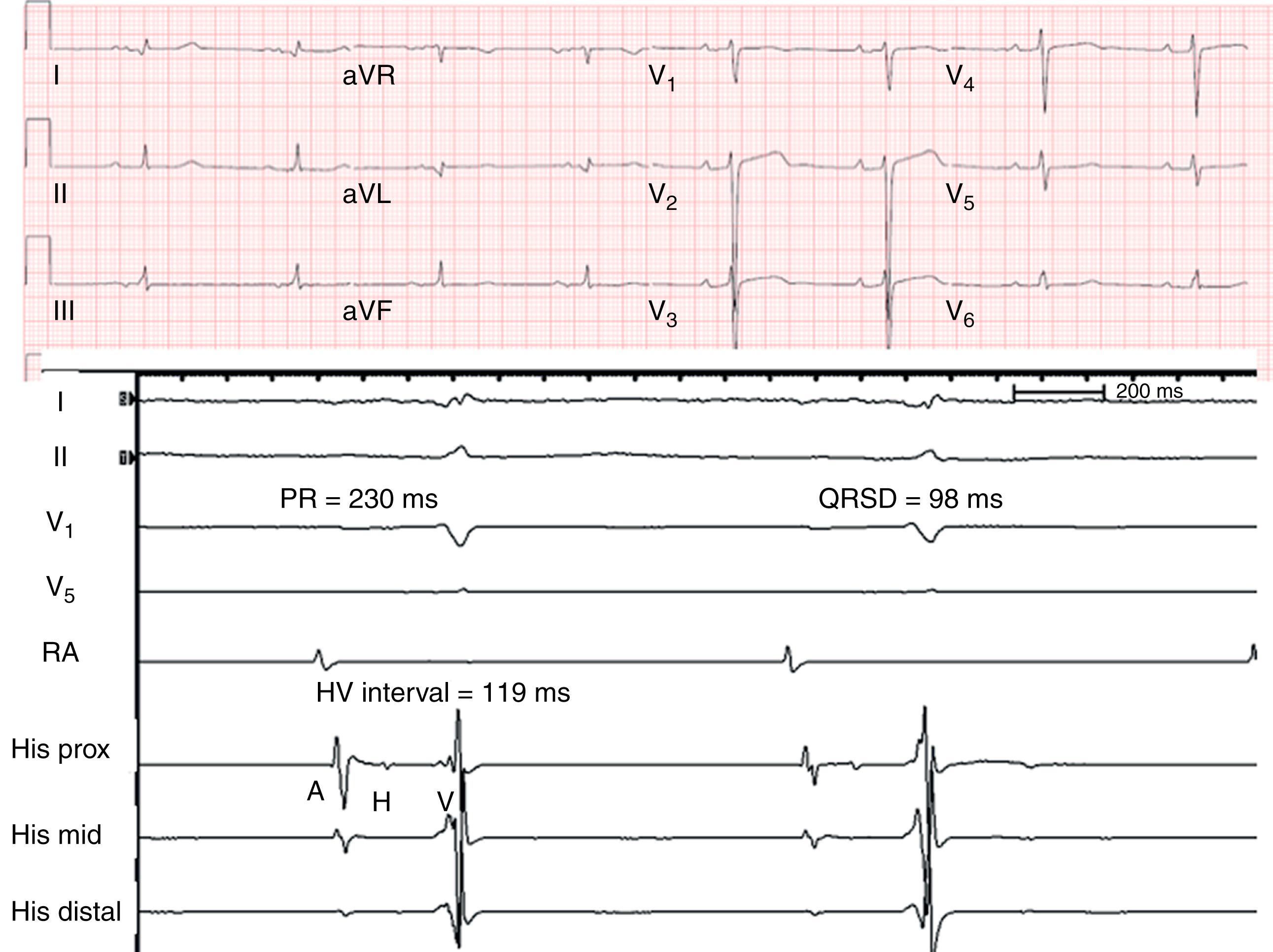 Fig. 106.1, 12-Lead electrocardiogram ( top ) and intracardiac recordings ( bottom ) in a patient with transthyretin cardiac amyloidosis.