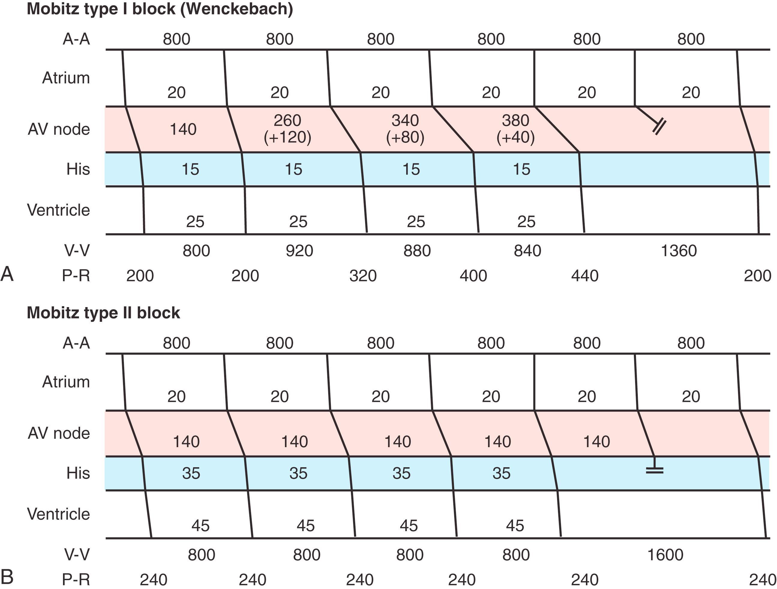 Fig. 106.2, (A) Ladder diagram demonstrating type I and type II second-degree atrioventricular (AV) block in Mobitz type I or Wenckebach block; progressive delay of the atrial impulse occurs in the AV node proximal to the His bundle. The greatest increment occurs in the second beat (+120 ms) and becomes less in subsequent beats (+80 ms and +40 ms), leading to gradual shortening of the RR interval (920 ms–880 ms–840 ms). The pause measures less than the sum of two PP intervals (1360 ms). (B) Mobitz type II AV block is not preceded by PR interval lengthening, and the pause equals two PP intervals. The site of block is usually distal to the AV node. Activation times in the diagrams are given in milliseconds (ms); double bars indicate conduction block. A, Atrium; V, ventricle.