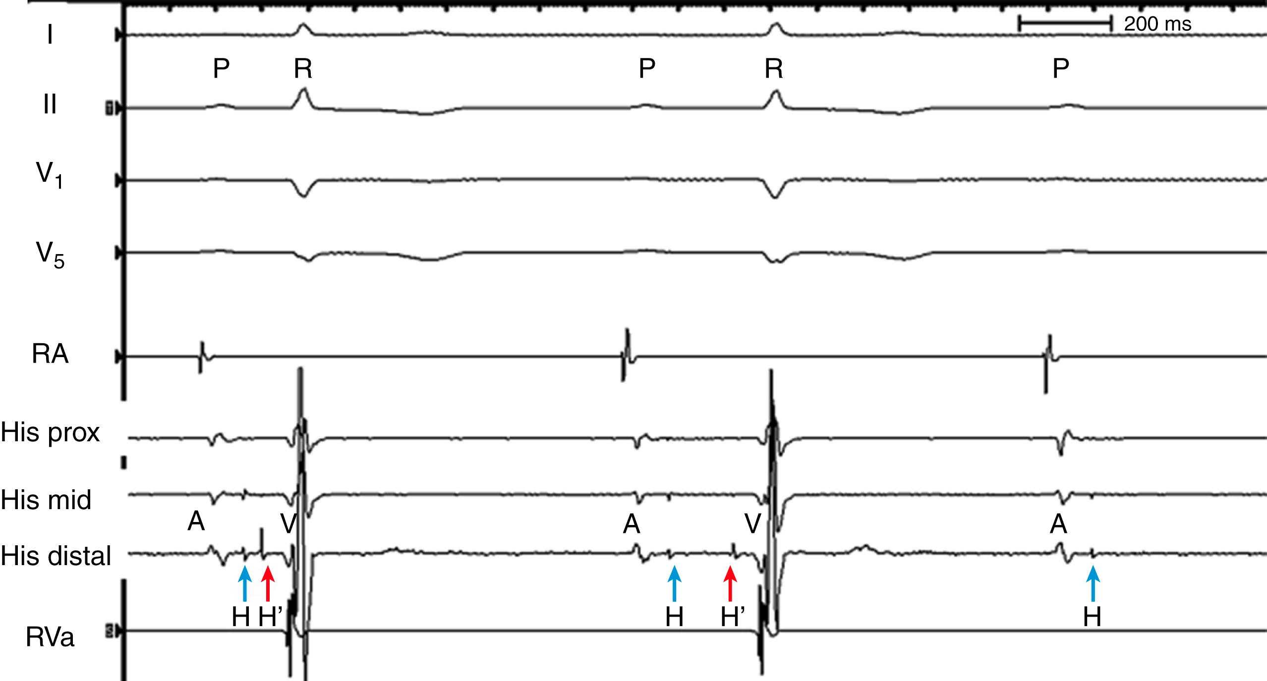 Fig. 106.3, Intracardiac recording showing Wenckebach atrioventricular block at the level of the His bundle in a patient with exertional dyspnea.