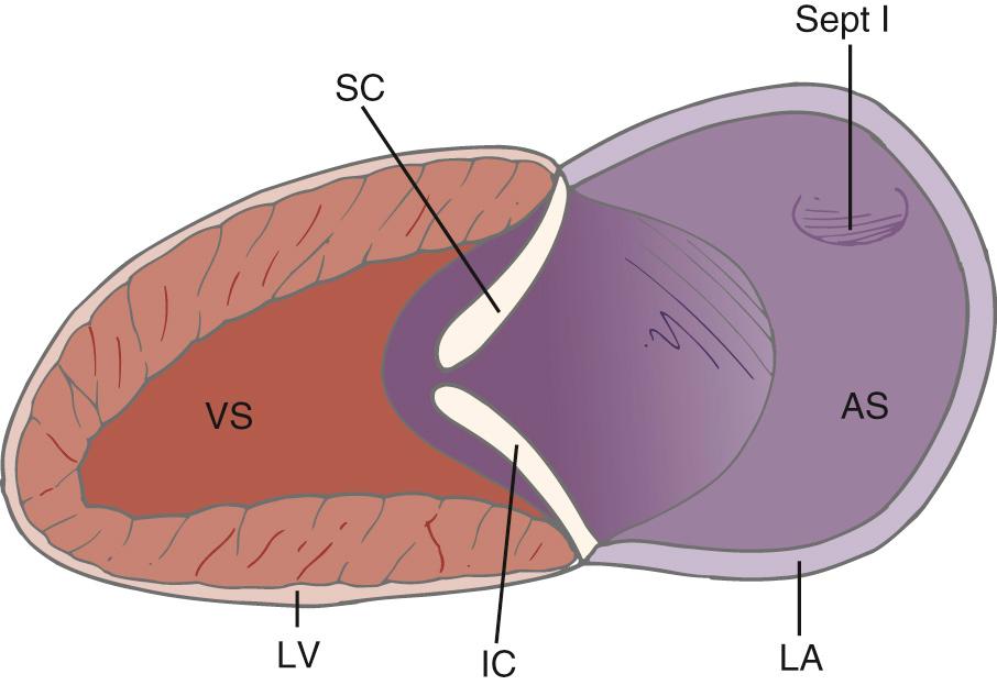 FIGURE 116-1, Schematic of complete atrioventricular (AV) canal defect during morphogenesis, with the AV canal region shown in dark gray . Projections from the superior and inferior endocardial cushions normally differentiate into the AV valves and AV septum. AS, Atrial septum; IC, inferior endocardial cushion; LA, left atrium; LV, left ventricle; SC, superior endocardial cushion; Sept 1, septum primum; VS, ventricular septum.