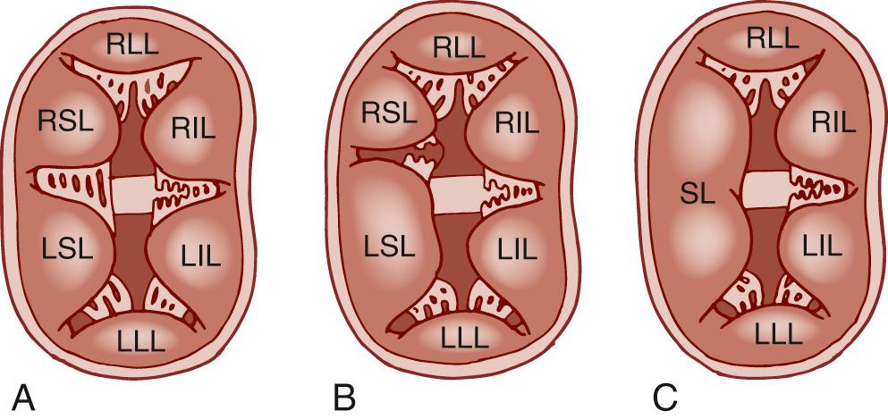 FIGURE 116-2, The Rastelli classification for complete atrioventricular canal defects. A, In the Rastelli type A defect, the superior bridging leaflet is divided into two leaflets at the crest of the interventricular septum, corresponding to the right superior leaflet (RSL) and the left superior leaflet (LSL). B, In the Rastelli type B defect, the LSL bridges across the septum and attaches to a papillary muscle in the right ventricle. C, In the Rastelli type C defect, there is marked bridging of the superior bridging leaflet (SL), making it free floating and unattached to the underlying interventricular septum. LIL, Left inferior leaflet; LLL, left lateral leaflet; RIL, right inferior leaflet; RLL, right lateral leaflet.