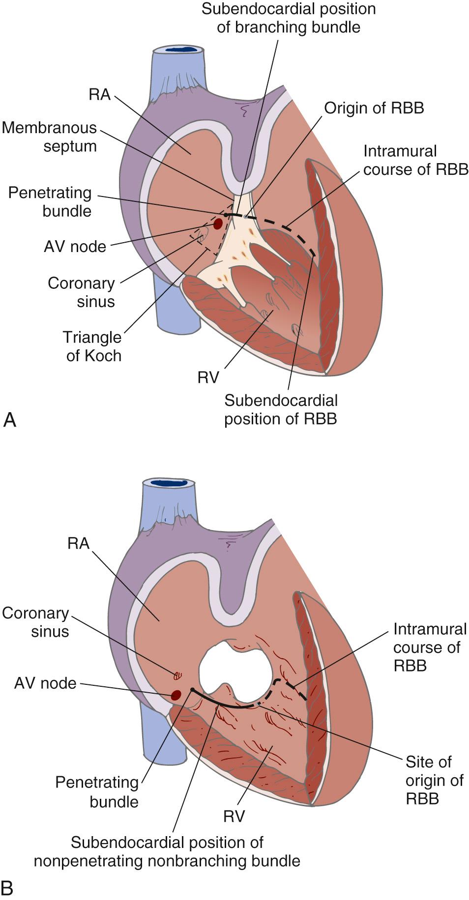 FIGURE 116-3, The location of the atrioventricular (AV) node and the conduction tissue. A, Normal heart. Note the location of the AV node at the tip of the triangle of Koch. B, AV canal heart. The AV node is now located in the nodal triangle, not at the tip of the triangle of Koch. The coronary sinus, AV node, and bundle of His are displaced inferiorly compared with the normal heart. RA, Right atrium; RBB, right bundle branch; RV, right ventricle.