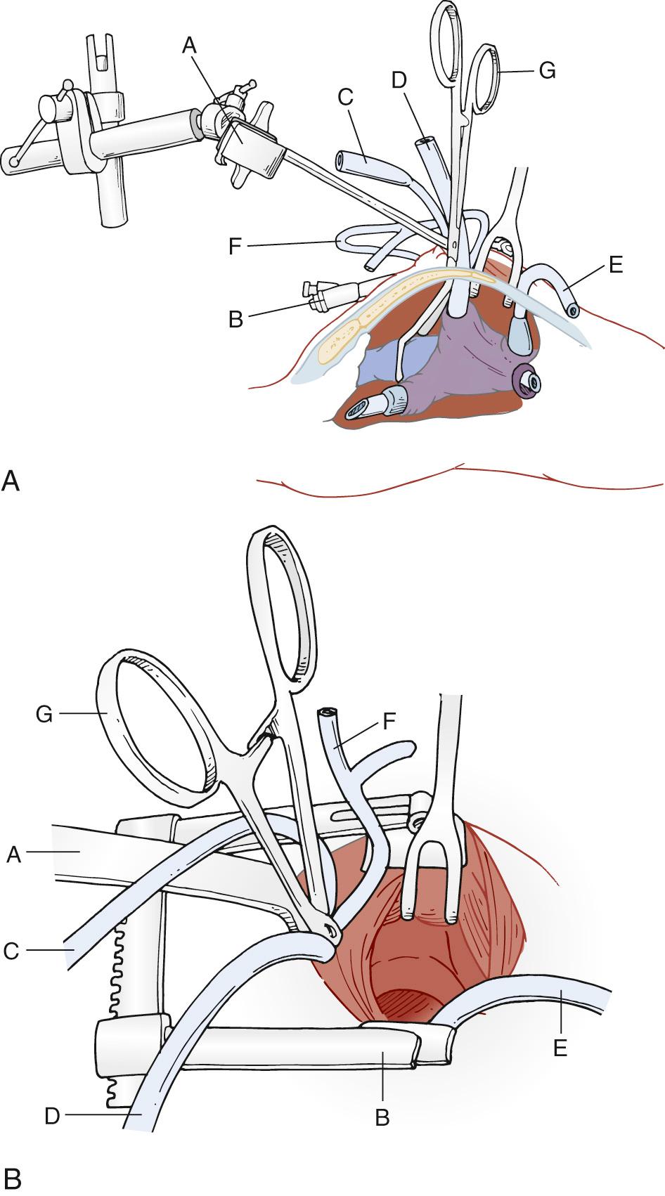 FIGURE 116-4, Mini-sternotomy setup for repair of atrioventricular (AV) canal defects. A, Representative parasagittal cross-section with bicaval cannulation and aortic cross-clamping. B, Surgeon's view of the operative field. The inside of the atrium is well visualized for AV canal repair. A, Bookwalter retractor arm connected to an army-navy retractor; B, pediatric sternal retractor; C, aortic cannula; D, superior vena cava cannula via the right atrium, although direct cannulation is preferred for complete AV canal repair; E, inferior vena cava cannula; F, cardioplegia cannula; G, aortic crossclamp.