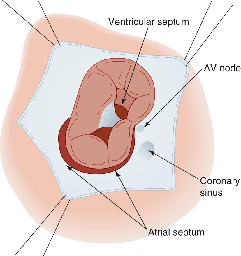 FIGURE 116-5, Surgeon's view of complete atrioventricular (AV) canal defect. The superior bridging leaflet (left) is undivided and unattached to the underlying crest of the interventricular septum, as in a Rastelli type C defect. The AV node and coronary sinus ostium are displaced inferiorly. There is a cleft between the left superior and inferior leaflets. A large ostium primum defect is present, allowing good visualization into the left atrium.