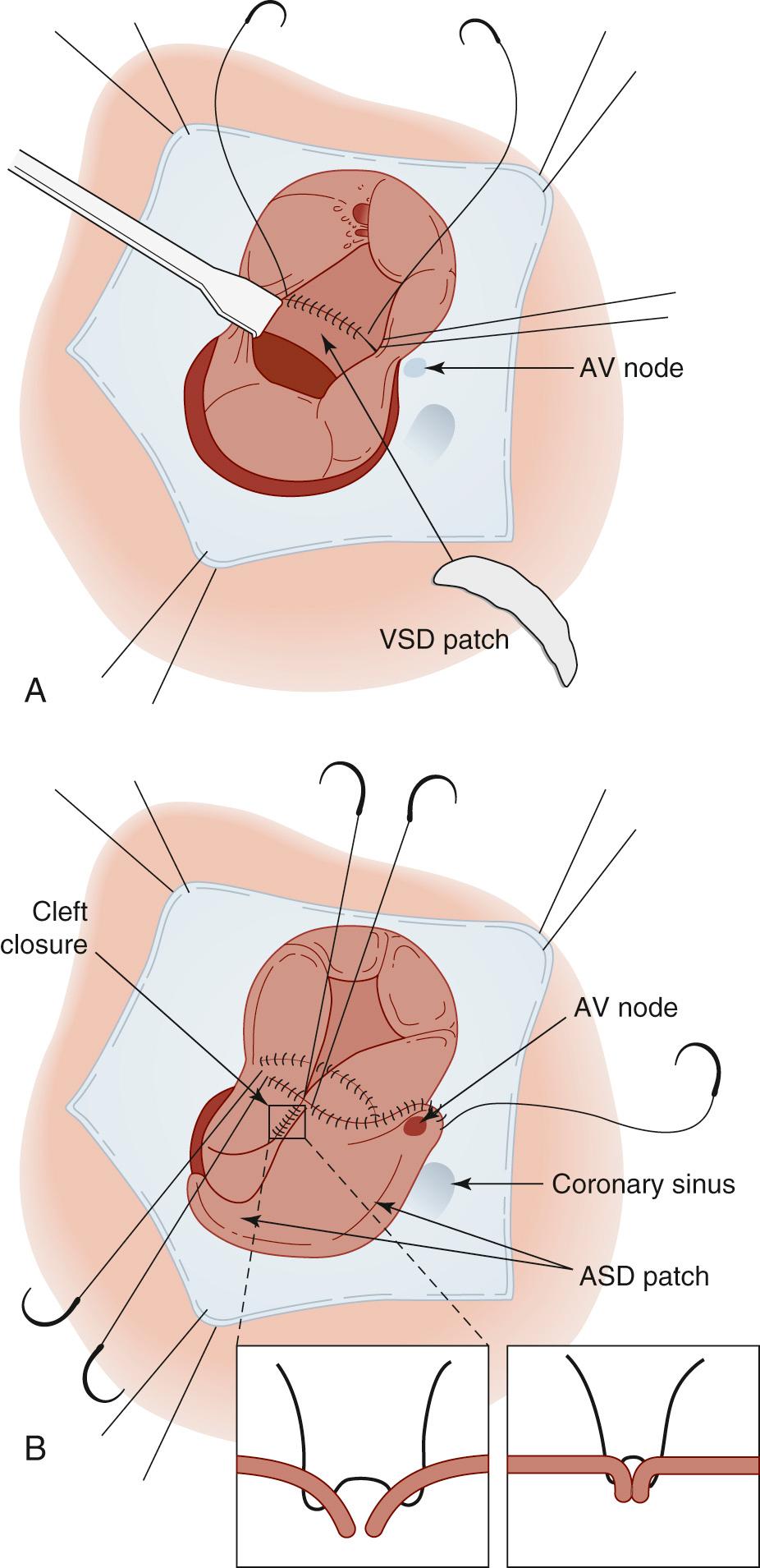 FIGURE 116-6, The double-patch technique for repair of complete atrioventricular (AV) canal defects. A, Placement of the crescent-shaped ventricular septal defect (VSD) patch, showing suturing to the crest of the interventricular septum. The superior leaflet is retracted cephalad to allow accurate suturing without entrapment of chordae. Similar retraction is used at the inferior leaflet, where the patch is sewn to the right of the crest of the interventricular septum to avoid iatrogenic injury to the AV node. B, Completion of the double-patch repair is achieved by inserting the atrial septal defect (ASD) patch. Sutures are passed through the VSD patch, valve leaflets, and ASD patch, thereby sandwiching the valve between the two patches. In this example, the ASD patch is sewn to the right of the AV node and to the left of the coronary sinus. If a secundum defect or patent foramen is present, the ASD patch can be extended to cover both defects. Cleft closure is usually completed once the valve leaflets are attached to the ASD and VSD patches. Inset, Apposition of the cleft edges during systole.