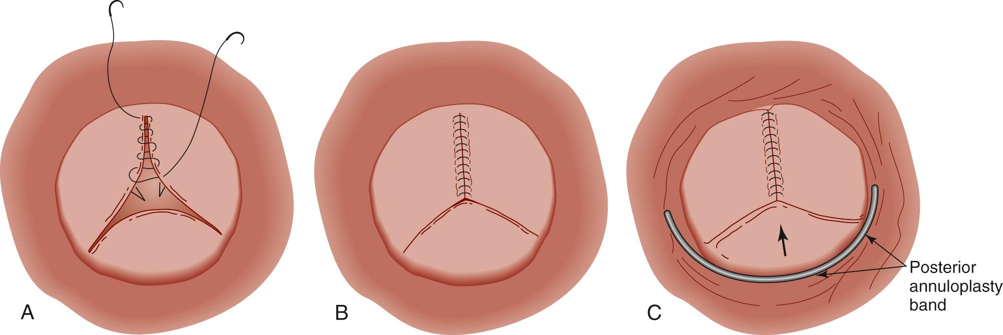 FIGURE 116-7, Closure of the left atrioventricular (AV) valve cleft. Once the leaflets are attached to the ventricular septal defect and atrial septal defect patches, the zone of apposition of the superior and inferior bridging leaflets is usually well aligned. The cleft is then closed in two layers. A, The first layer is a running mattress suture, apposing the edges of the leaflets. B, The second running simple suture line ensures apposition of the leaflet edges. C, When there is significant annular dilation, a posterior annuloplasty is performed by inserting a flexible partial ring from the anterior fibrous continuity with the aortic valve to just posterior to the interatrial septum. The latter should remain 3 to 4 mm posterior to the junction between atrial septum and AV valve annulus to avoid injury to conduction tissue.