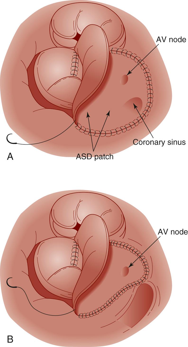 FIGURE 116-8, Placement of the atrial septal defect (ASD) patch. A, The ASD patch can be placed entirely to the right of the atrioventricular (AV) node and coronary sinus, leaving the coronary sinus on the left atrial side of the newly constructed septum. B, Alternatively, the patch can be placed to the right of the AV node, but by turning the suture line back to the left of the coronary sinus, the sinus is left on the right atrial side.