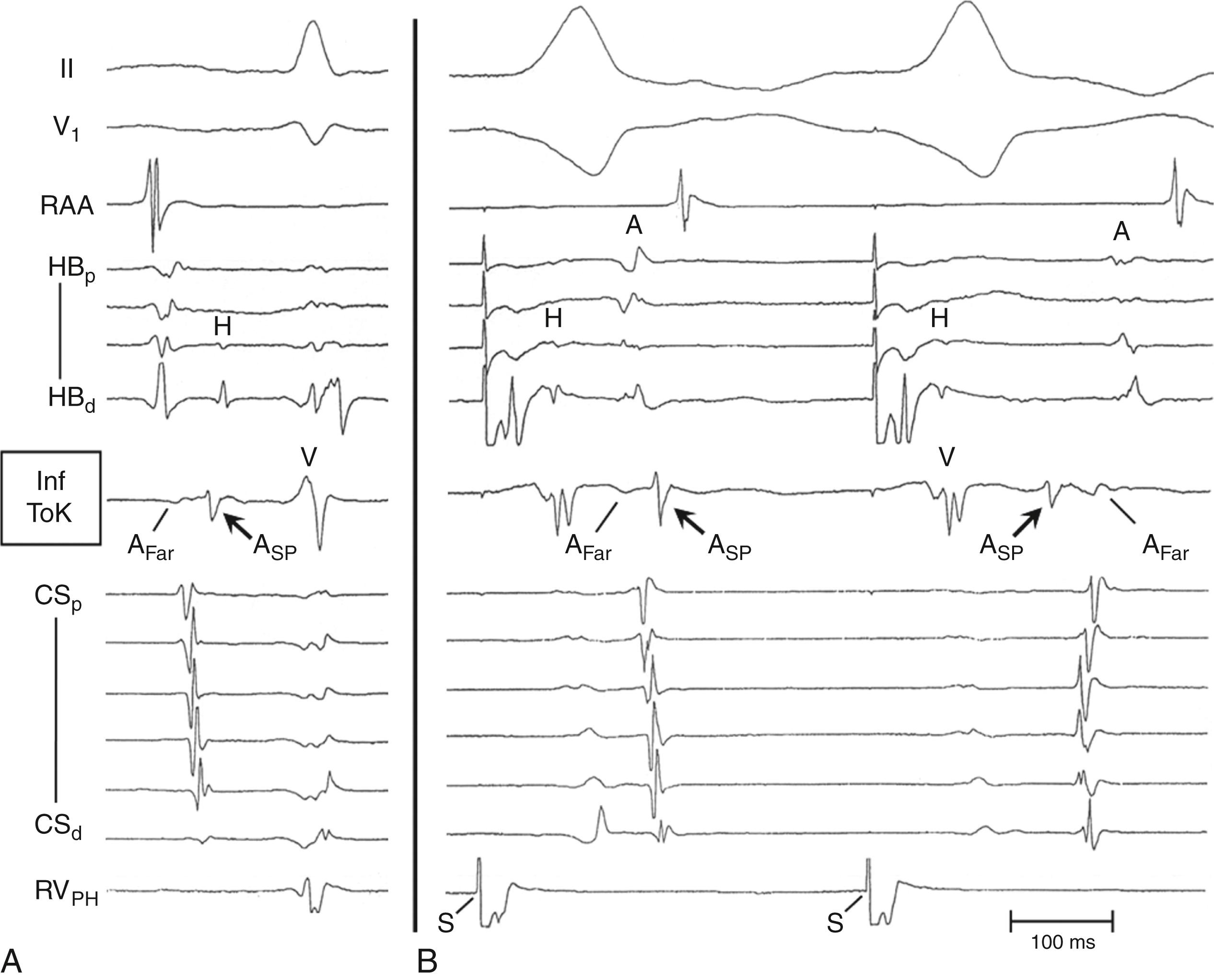 Fig. 72.2, Different atrial activation sequence during retrograde conduction over the fast pathway (FP) and a slow pathway (SP) formed by the rightward inferior extension (RIE) of the atrioventricular (AV) node.