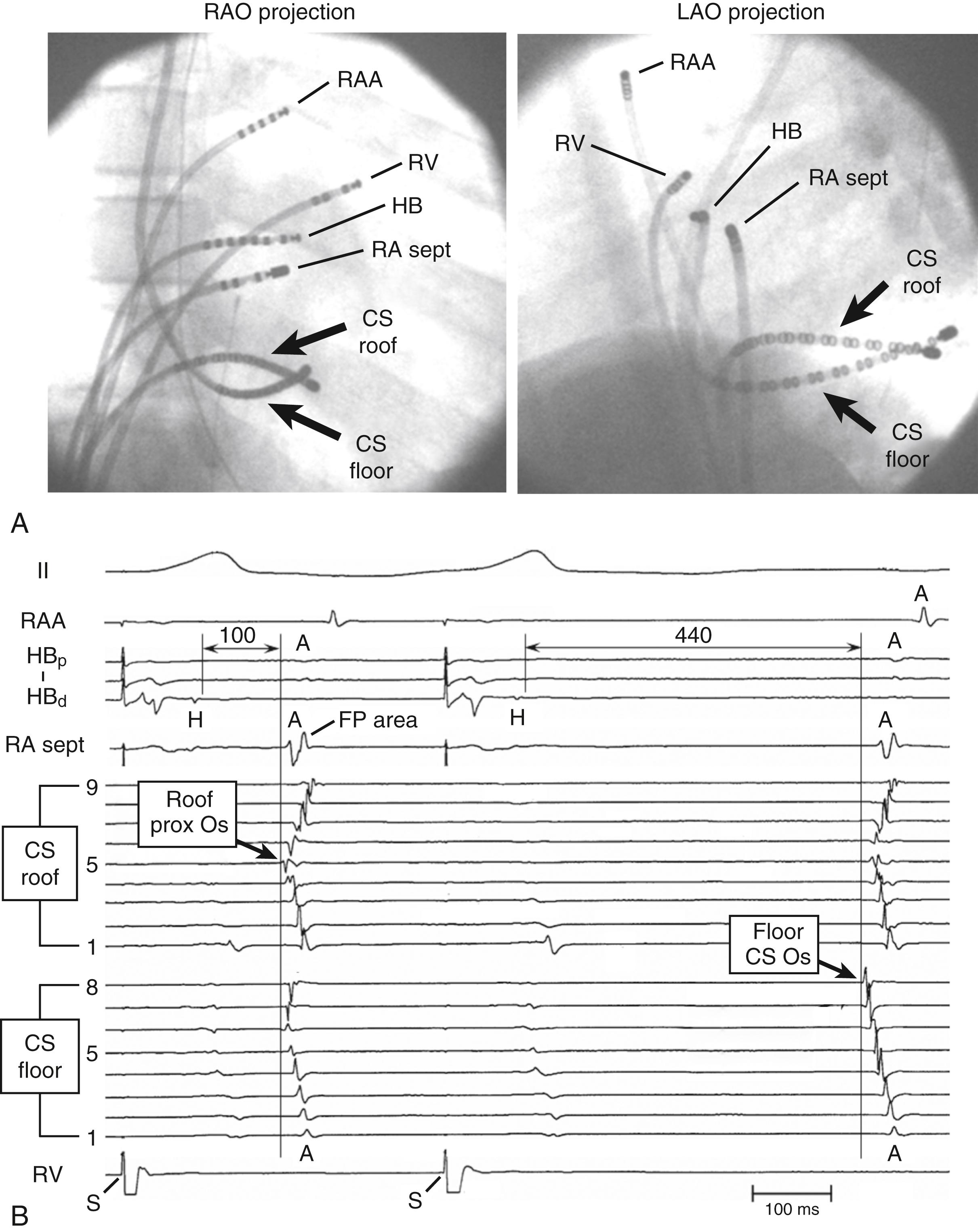 Fig. 72.12, Pattern of atrial activation after retrograde conduction over two different slow pathways (SPs): the rightward inferior extension (RIE) and leftward inferior extension (LIE).