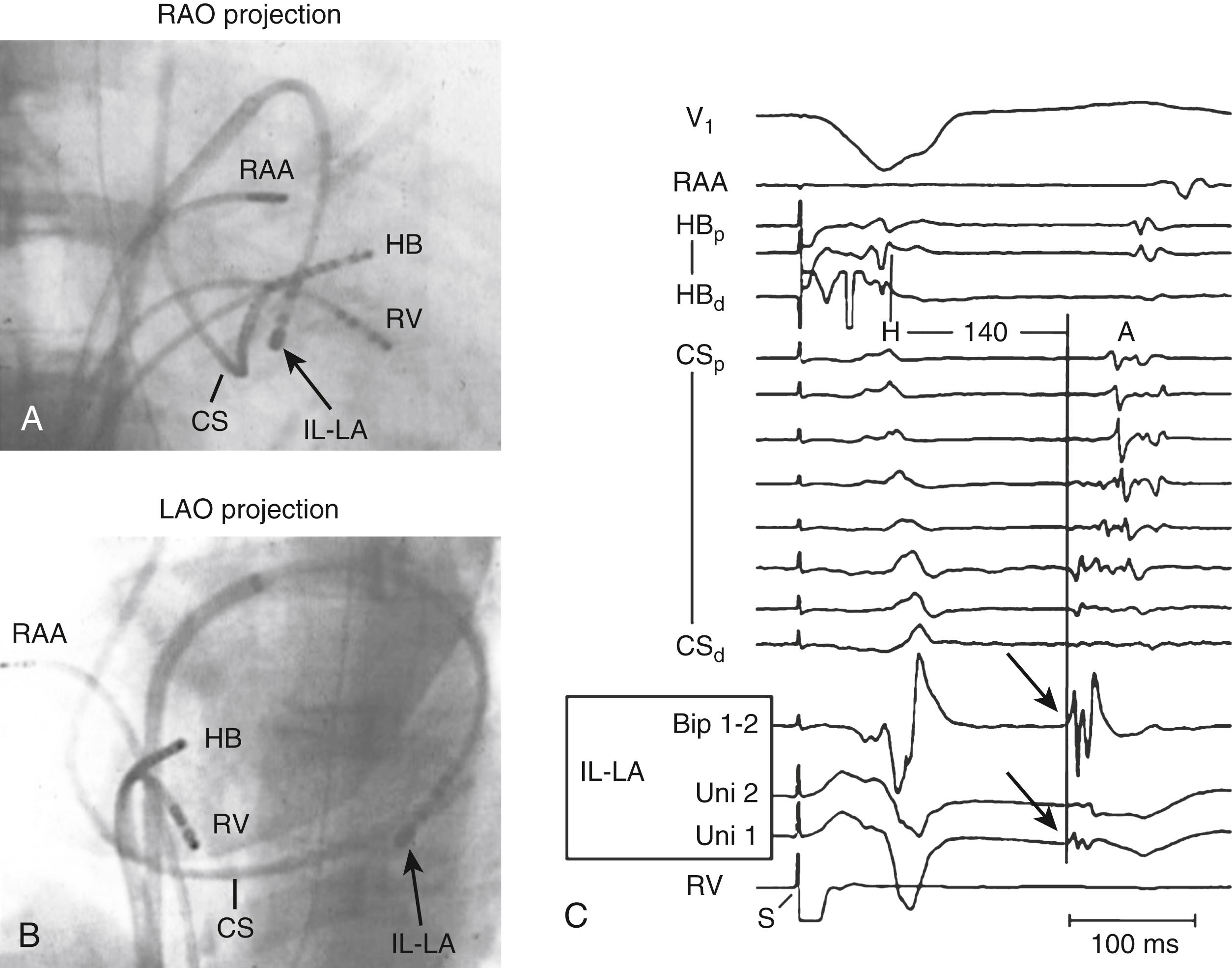 Fig. 72.13, Retrograde conduction over the inferolateral left atrial slow pathway.