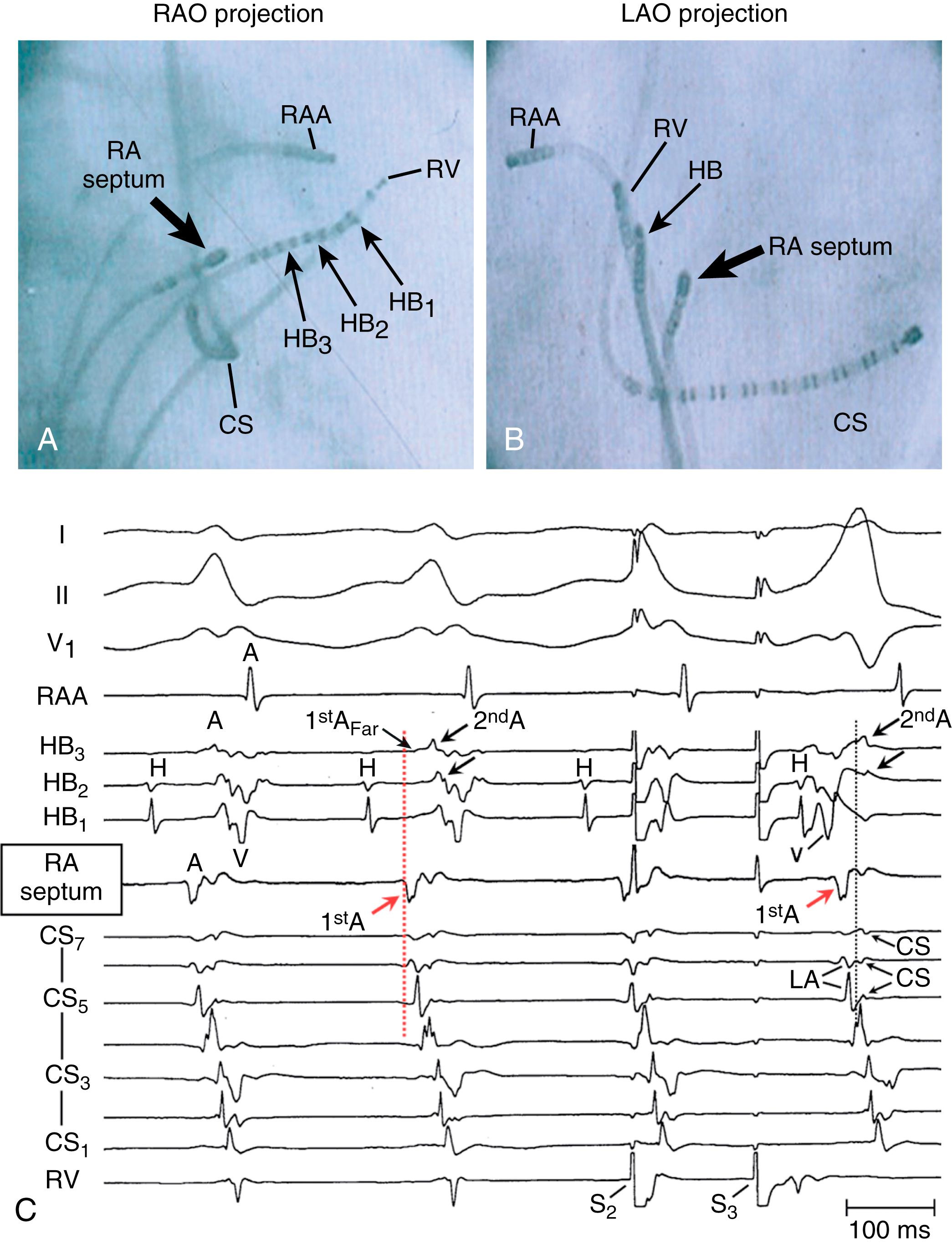 Fig. 72.3, Pattern of atrial activation during Slow/Fast atrioventricular nodal reentrant tachycardia (AVNRT).