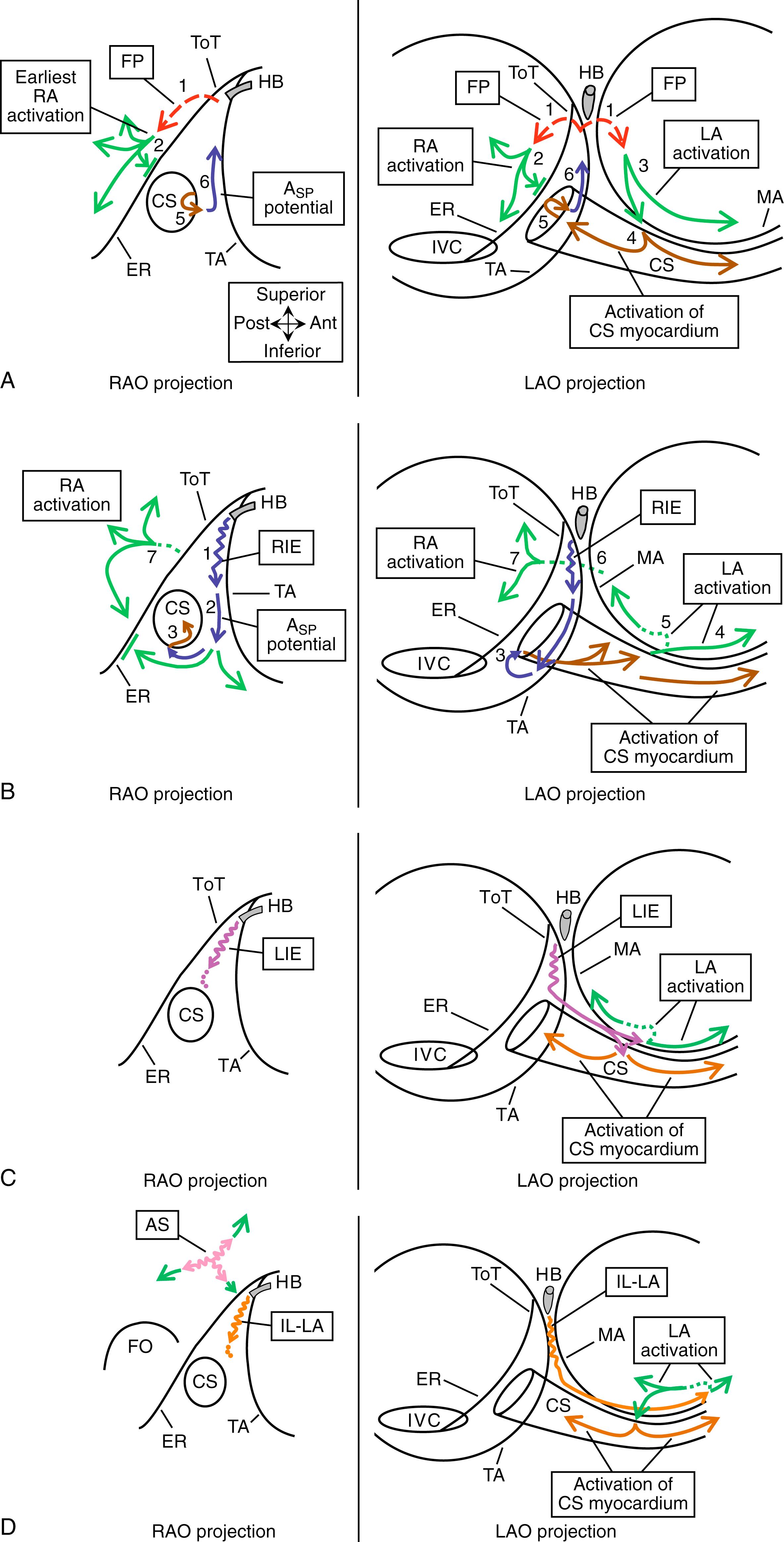 Fig. 72.4, (A) Proposed pattern of atrial activation during retrograde conduction over the fast pathway (FP). Retrograde FP conduction ( dotted red arrows 1 ) activates the right and left atrium at the interatrial septum, posterior to the tendon of Todaro (ToT) outside the triangle of Koch (ToK). Right atrial activation propagates away in the posterior, superior, and inferior directions (RA activation , green arrows 2 ). This results in superior-to-inferior right atrial activation along the eustachian ridge (ER) outside the ToK. This right atrial wavefront is unable to cross the ER and ToT to enter the ToK, presumably because of conduction block at the ER ( short perpendicular green line ). Left atrial activation propagates inferiorly ( green arrows 3 in left anterior oblique [LAO] projection) and activates the coronary sinus (CS) myocardium, 1 to 3 cm from the ostium ( brown arrows ). The reentrant impulse propagates along the CS myocardium to the CS ostium ( brown arrows 4 ) where it activates the inferior ToK ( brown arrow 5 ), producing the A SP potential, with activation proceeding in the inferior-to-superior direction along the inferior ToK ( blue arrows 6 ). (B) Postulated pattern of activation during retrograde conduction over the rightward inferior extension (RIE) of the atrioventricular (AV) node. Retrograde conduction over the RIE ( blue arrows ) activates the myocardium between the inferoseptal tricuspid annulus (TA) and the CS ostium (inferior ToK) to produce the retrograde A SP potential ( blue arrow 2 ) and then activates the CS at the floor of the ostium ( brown arrows 3 ). Activation in the ToK does not cross the ER to the right atrium ( perpendicular green line ) but proceeds leftward along the CS myocardium ( brown arrows in LAO projection) to activate the left atrium. Left atrial activation propagates rapidly in the leftward direction ( solid green arrow 4 in LAO projection) but must reverse direction to propagate in the septal direction ( dotted green line 5 ). The reversal of direction produces late left atrial activation at the left atrial inferoseptal region and a second potential in proximal CS electrograms (recorded from the CS roof). This septal left atrial wavefront activates the interatrial septum ( dotted green line 6 ), which is followed by activation of the right atrium posterior to the ToT and ER ( green arrows 7 ), which produces a late far-field potential recorded from the inferior ToK. (C) Postulated pattern of activation during retrograde conduction over the leftward inferior extension (LIE) of the AV node. It is unknown whether retrograde conduction over the LIE ( purple arrows ) initially activates the left atrial myocardium close to the inferoseptal mitral annulus (MA ; top purple arrowhead in LAO projection) or the CS myocardium at the roof of the proximal CS ( lower purple arrowhead in LAO projection). During retrograde conduction over the LIE, CS activation ( brown arrows ) is recorded earliest at the CS roof, 1.5 to 4 cm from the ostium. (D) Postulated pattern of activation during retrograde conduction over the inferolateral left atrial SP (IL-LA) and the anterior superior SP (AS). Retrograde conduction over the IL-LA SP ( orange arrows ) activates the left atrium close to the inferolateral MA at the 4:30 to 5:00 o’clock position, as viewed in the LAO projection ( green arrows ). Right atrial mapping during retrograde conduction over the AS ( pink arrows ) records earliest activation at the anterior-superior aspect of the septum or medial right atrial free-wall. FO, Fossa ovalis; IVC, inferior vena cava.