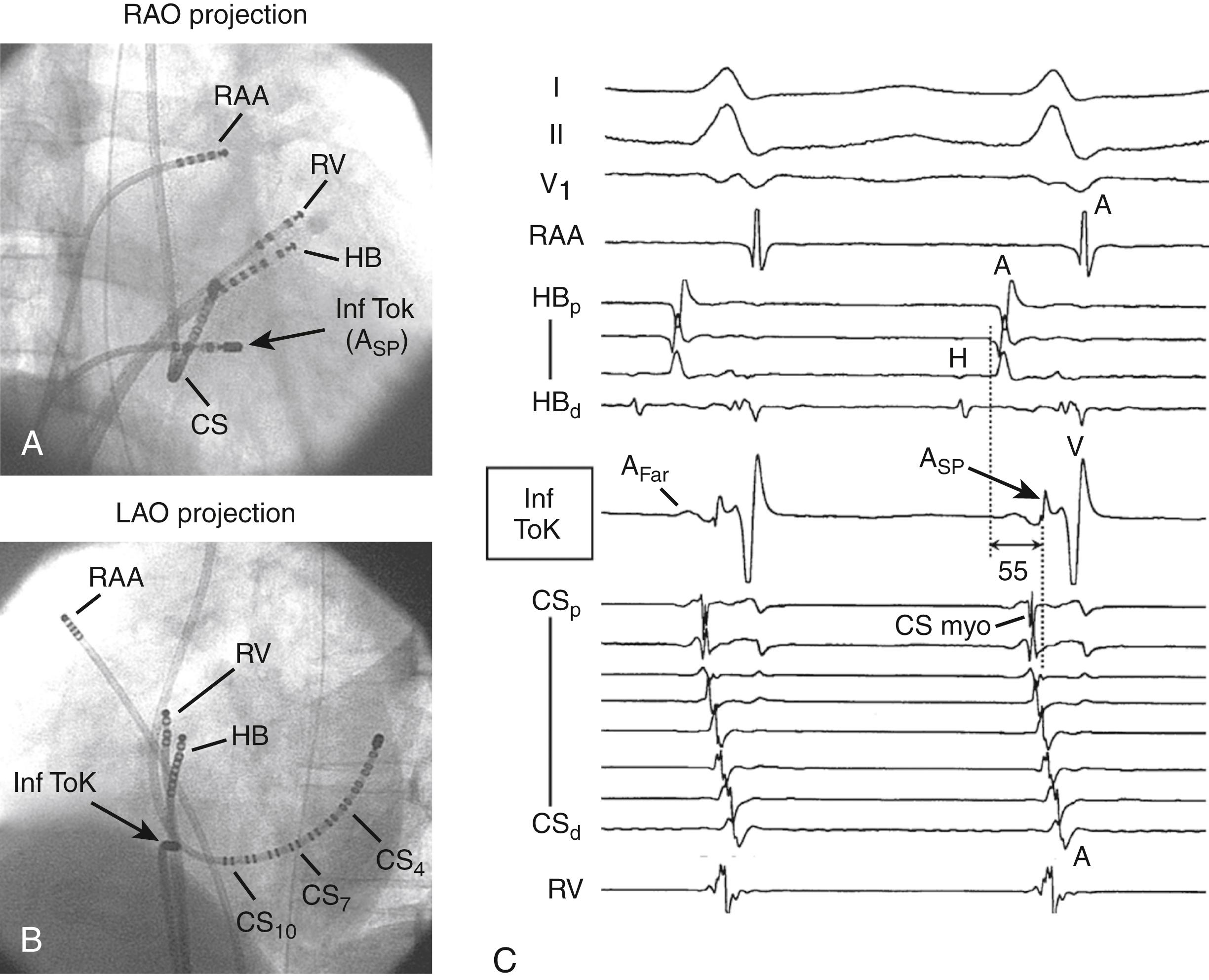 Fig. 72.5, Late timing of atrial activation at the inferior triangle of Koch (ToK) during Slow/Fast atrioventricular nodal reentrant tachycardia.