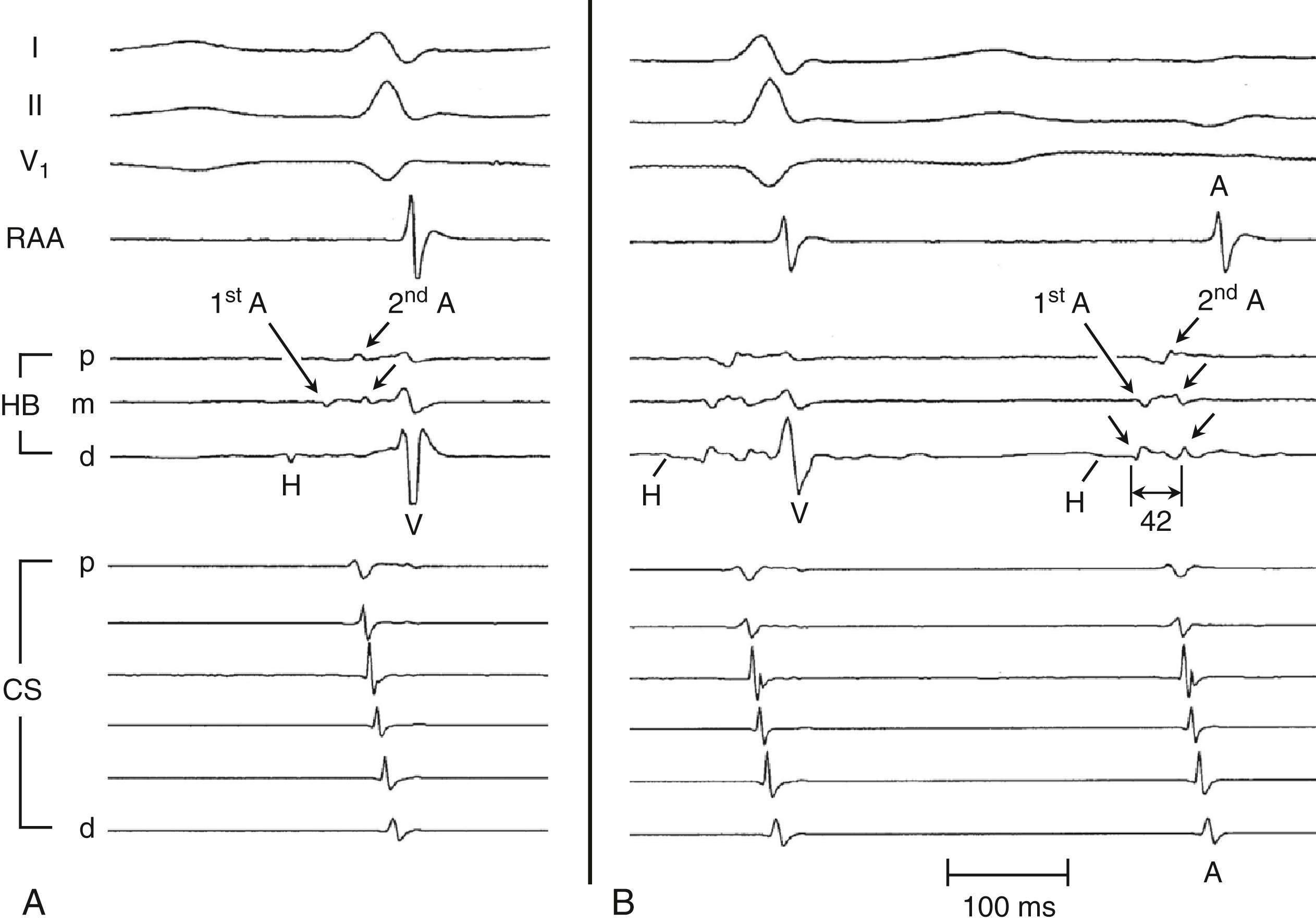 Fig. 72.6, Two distinct sets of atrial potentials recorded in the proximal His bundle (H) electrograms during Slow/Fast atrioventricular nodal reentrant tachycardia.