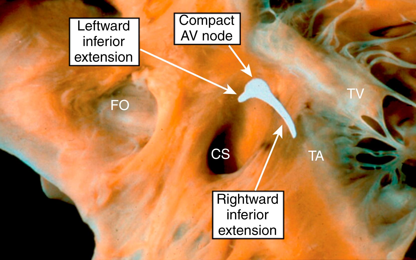 Fig. 72.7, Representation of the locations of the rightward and leftward inferior extensions of the atrioventricular (AV) node.