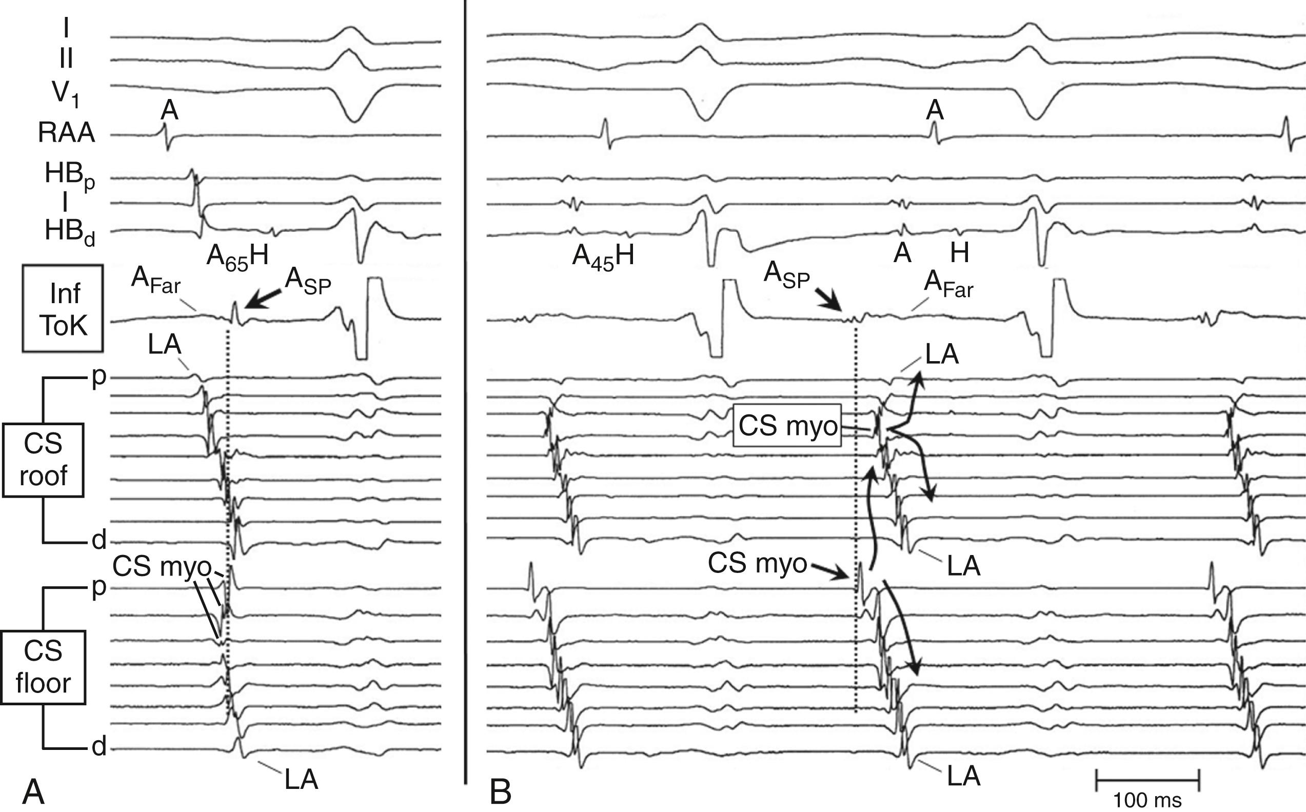 Fig. 72.8, Pattern of atrial activation during sinus rhythm and during Fast/Slow atrioventricular nodal reentrant tachycardia (AVNRT) using the leftward inferior extension (LIE) for the anterograde limb and the rightward inferior extension (RIE) for the retrograde limb of the tachycardia circuit.