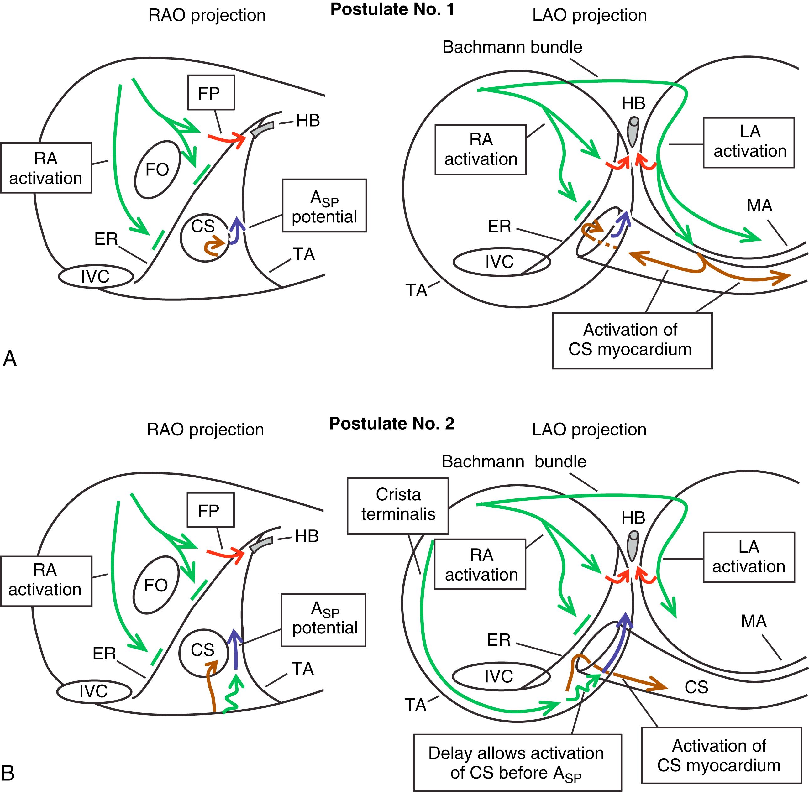 Fig. 72.9, Schematic representation of two possible patterns of activation during sinus rhythm that may explain the late A SP potential in the inferior triangle of Koch (ToK).