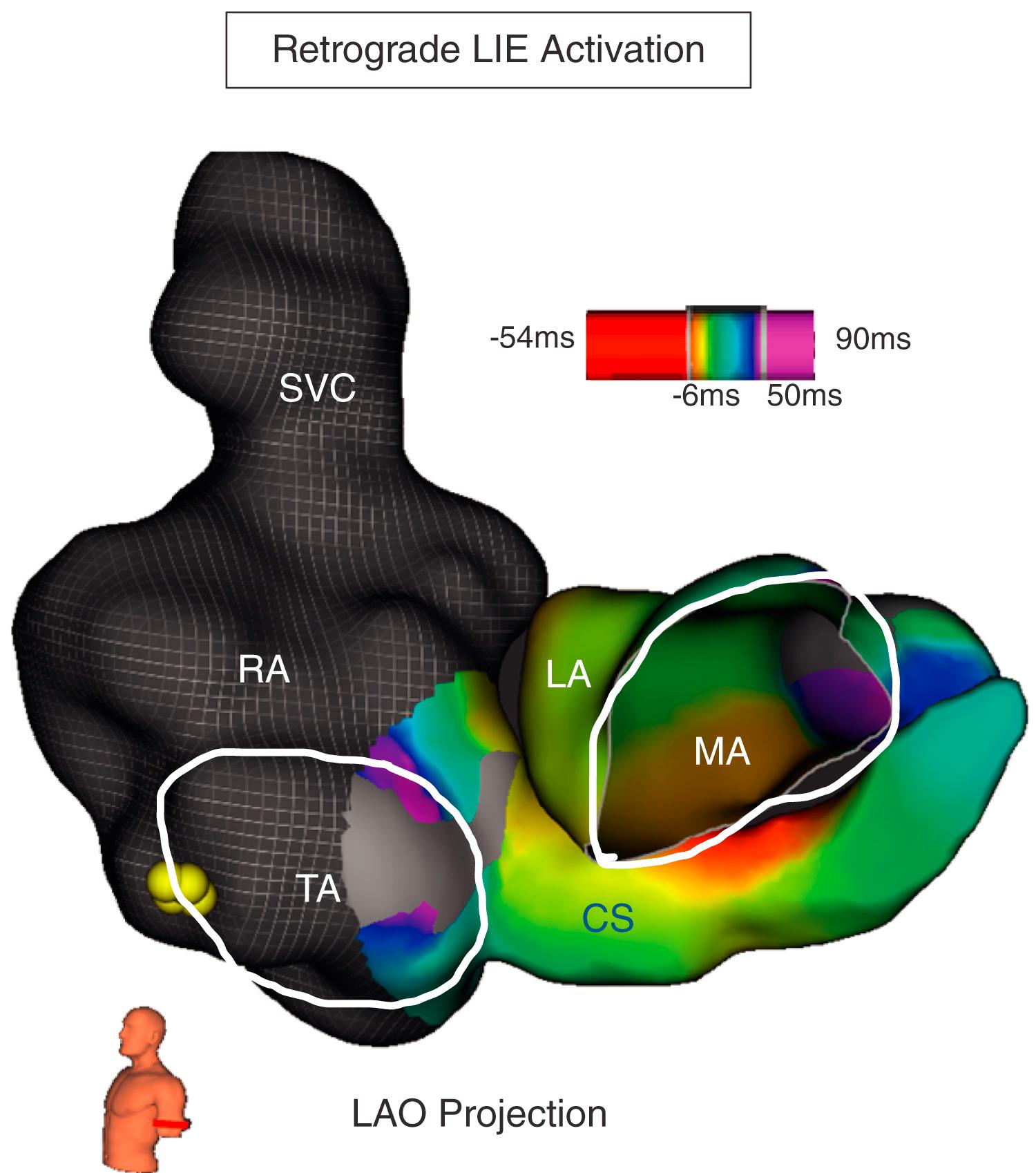 Fig. 72.10, High-density three-dimensional map of activation during retrograde conduction over the leftward inferior extension (LIE) of the atrioventricular (AV) node.