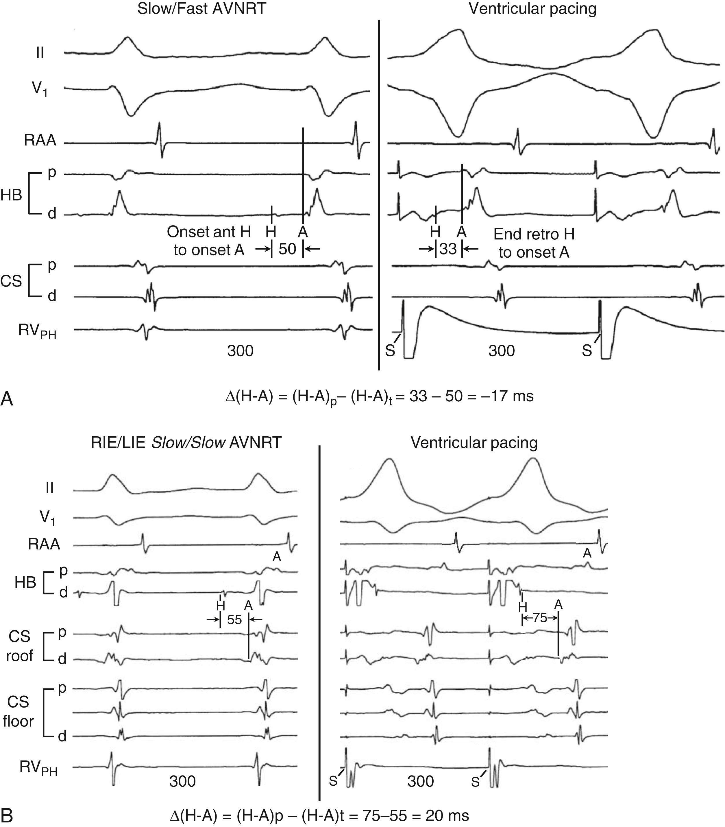 Fig. 72.11, Comparison of the H-A interval during tachycardia and during ventricular pacing for Slow/Fast atrioventricular nodal reentrant tachycardia (AVNRT) and Slow/Slow (rightward inferior extension [RIE]/leftward inferior extension [LIE]) AVNRT.