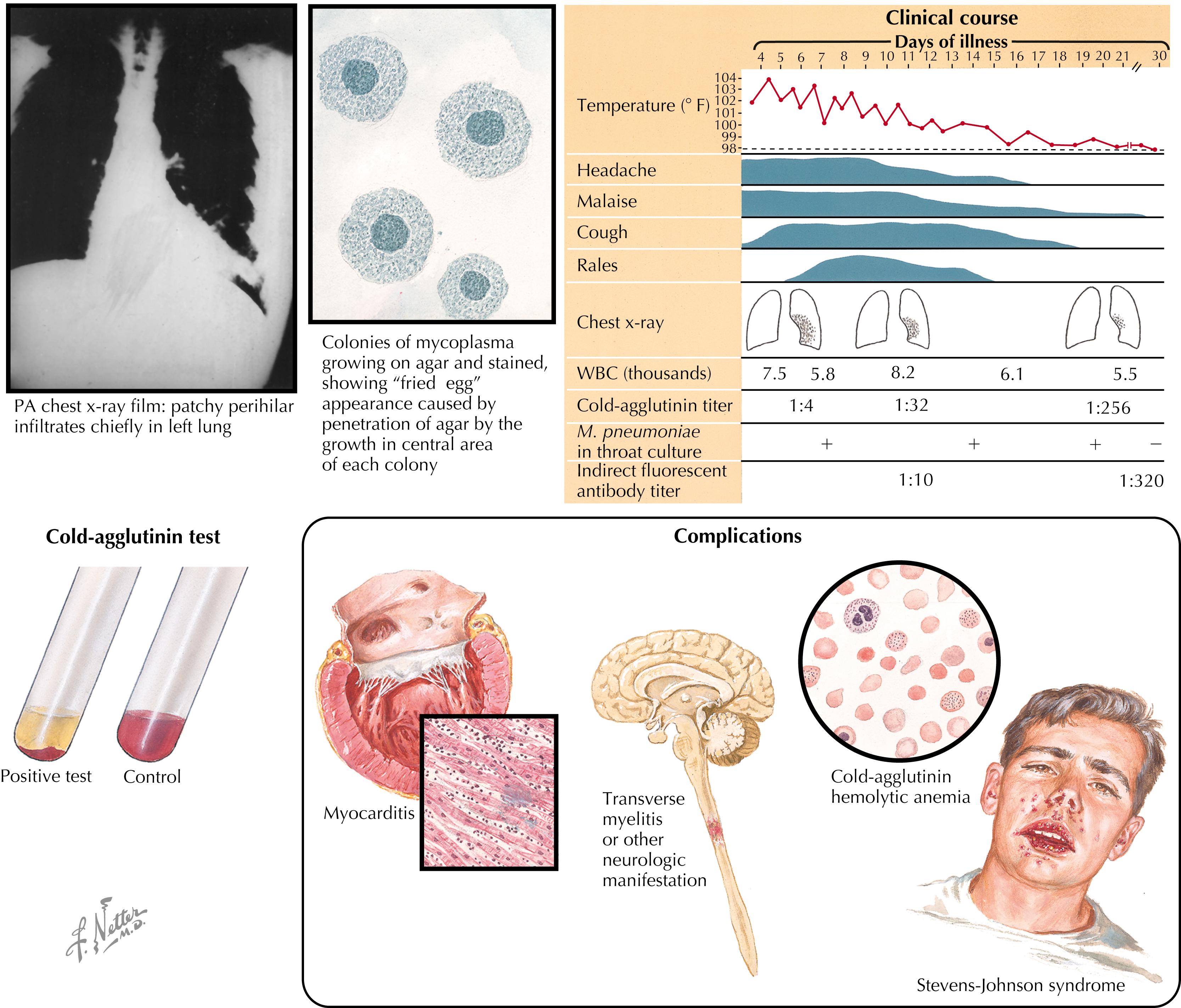 Fig. 28.1, Mycoplasma (Eaton agent) pneumonia (primary atypical pneumonia).