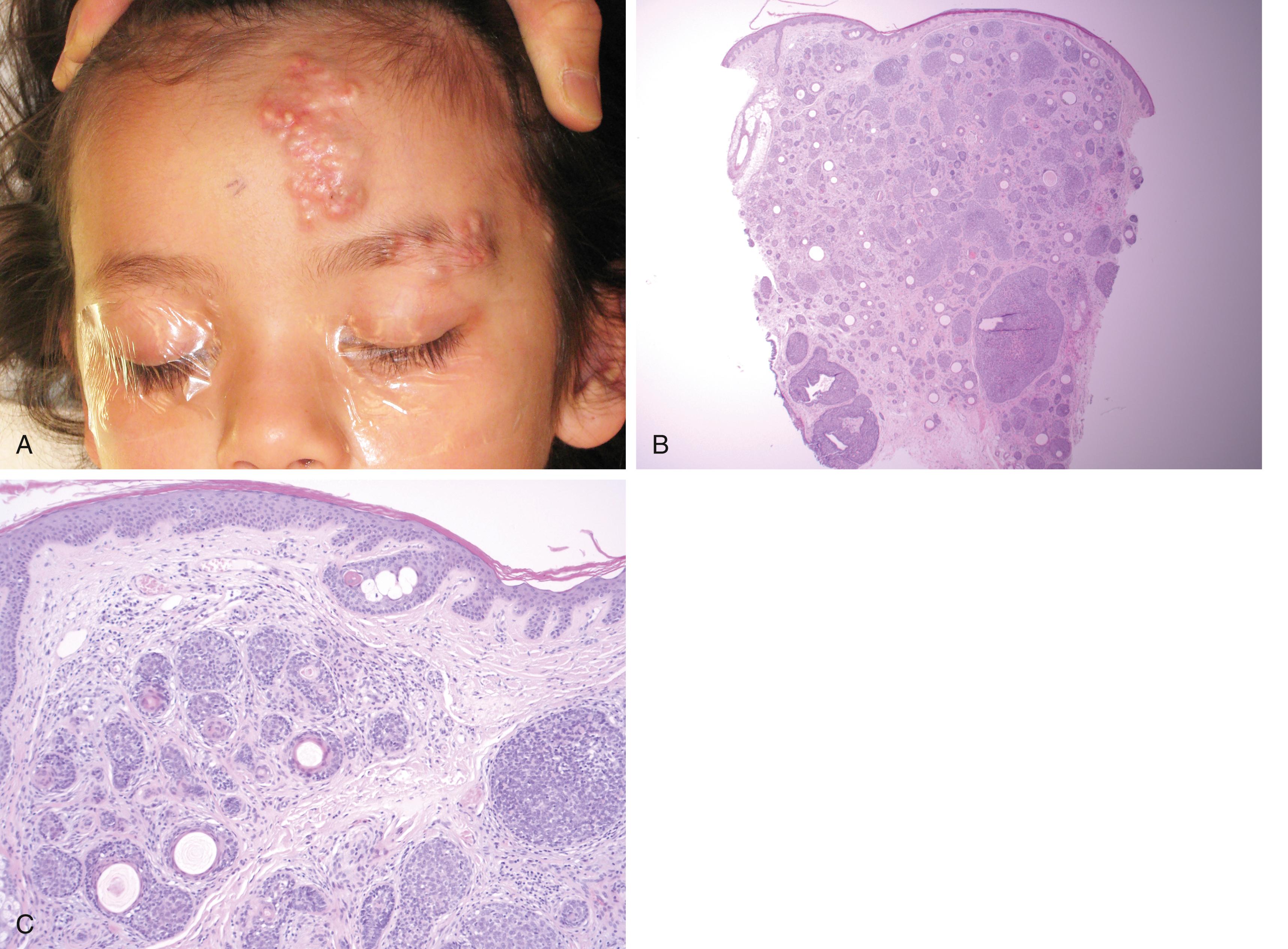 Fig. 10.2, (A) Six-year-old girl with multiple trichoepitheliomas within the V1 dermatome. No relatives had Brooke–Spiegler syndrome and therefore this may have been the result of a sporadic mutation. The main cluster was treated by simple excision. (B) Histopathology demonstrates nests of basaloid cells (without clefting) throughout the dermis with keratin microcysts. There is recapitulation of primitive hair bulbs, but no epidermal connection. (C) Desmoplastic trichoepithelioma demonstrating a “paisley-tie” pattern of strands and cords of basaloid cells, keratin microcysts, microcalcification, and stromal fibrosis.