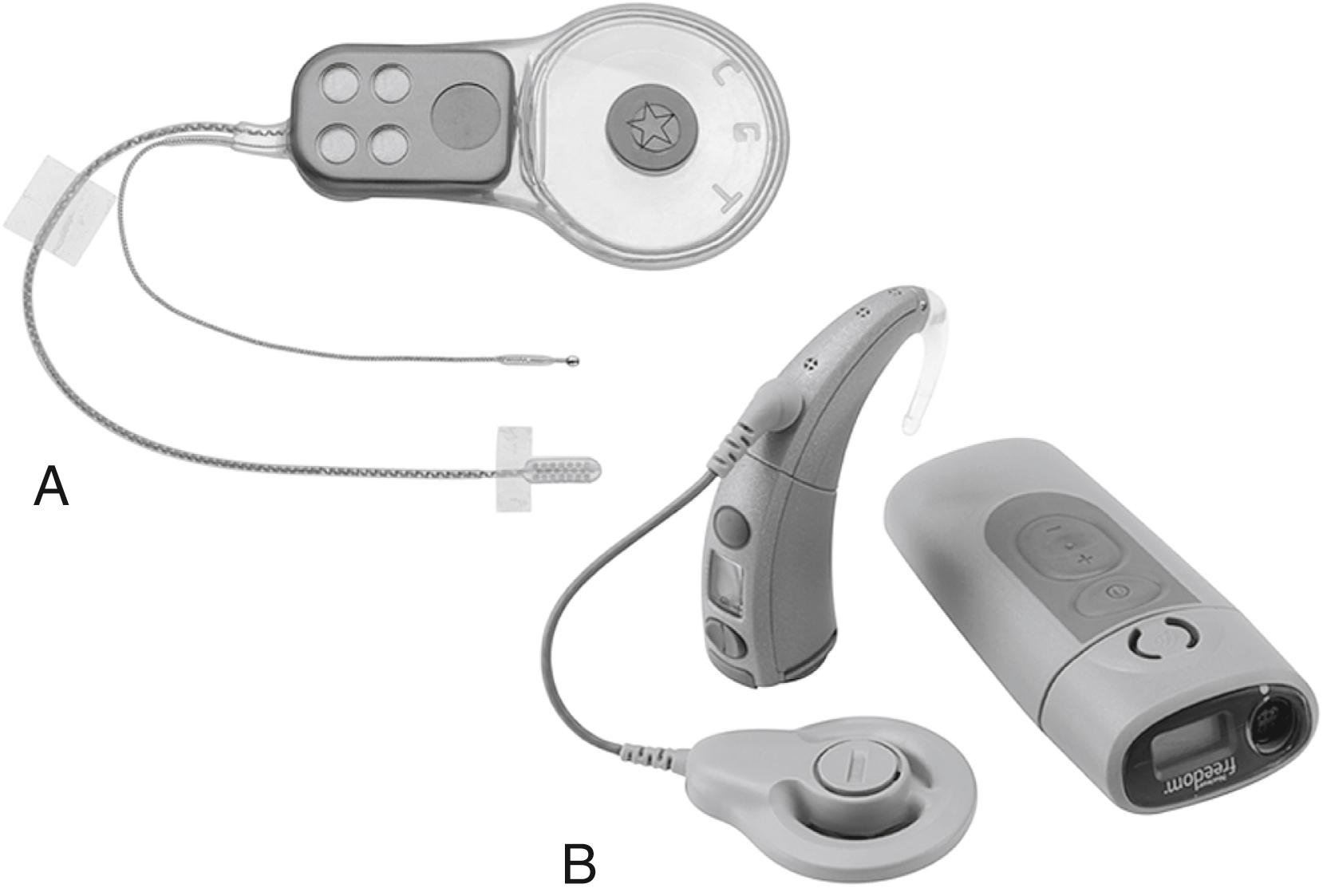 Fig. 53.1, (A) Auditory brainstem implant receiver and stimulator with 21-electrode array and remote ball ground electrode. (B) Freedom auditory brainstem implant processor with ear-level controller, transmitter coil, and the body-worn controller for longer battery life.