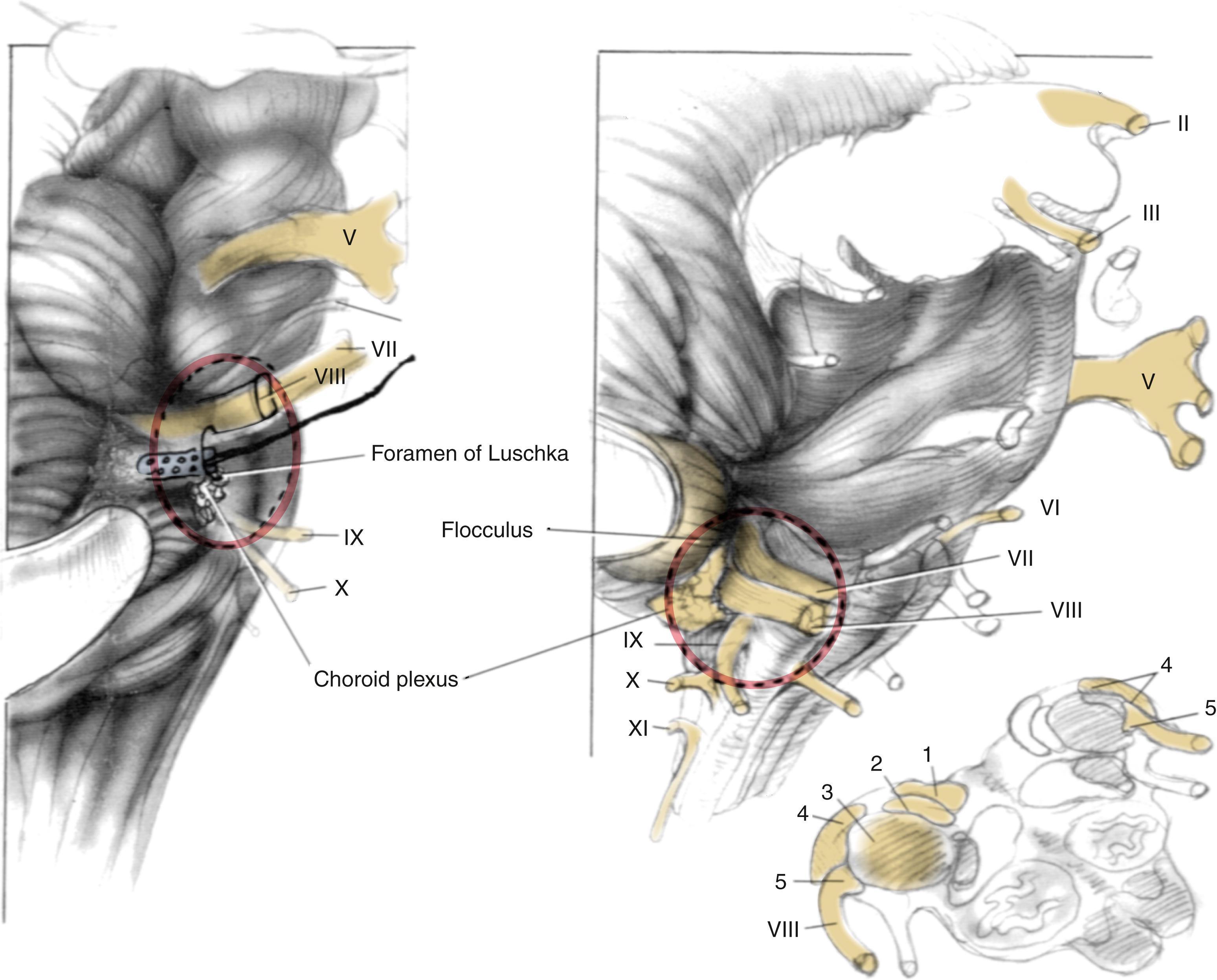 Fig. 53.2, Schematic of the cochlear nuclei region demonstrating the relative location of various landmarks.