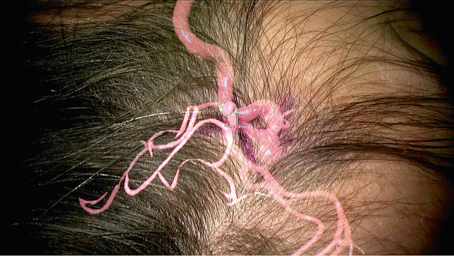 Figure 30.1, Augmented view through a navigated microscope of the left frontotemporal region, prior to surgical draping, in a patient positioned for clipping of a left middle cerebral artery (MCA) aneurysm.