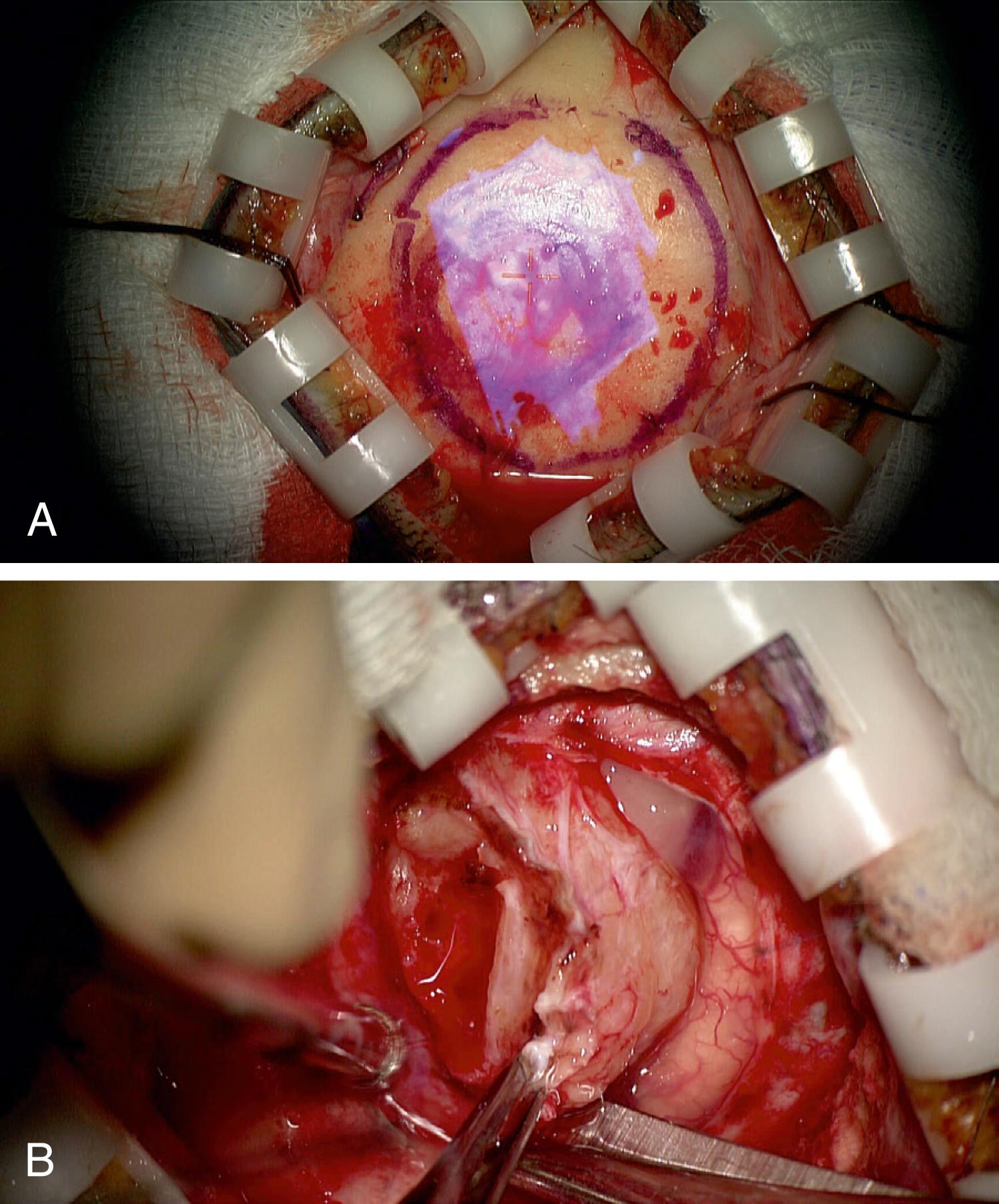 Figure 30.2, Use of augmented reality in skin incision and craniotomy planning.