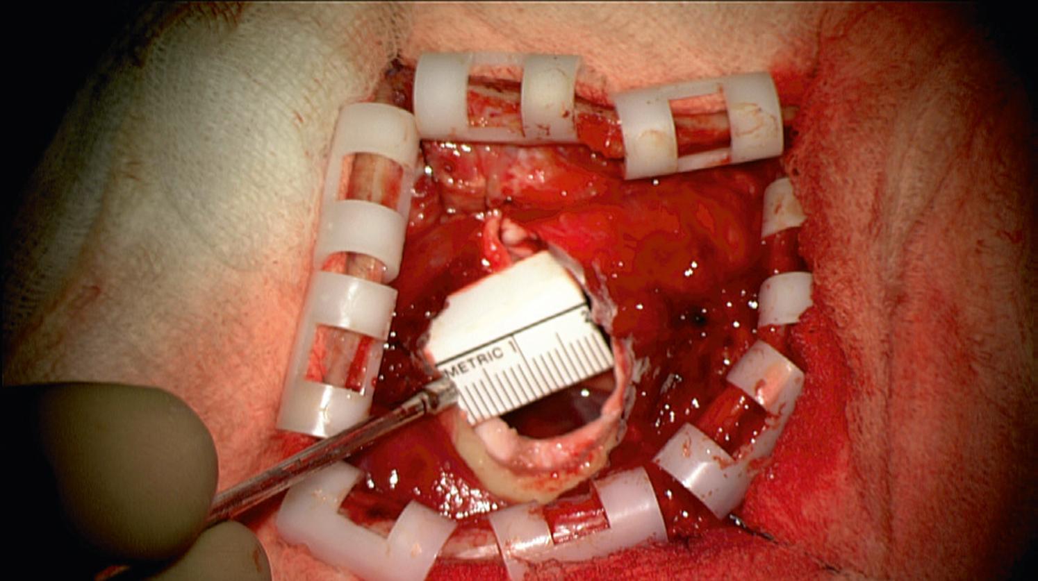 Figure 30.3, Mini–pterional craniotomy performed with augmented reality guidance for the clipping of an unruptured right middle cerebral artery bifurcation aneurysm.