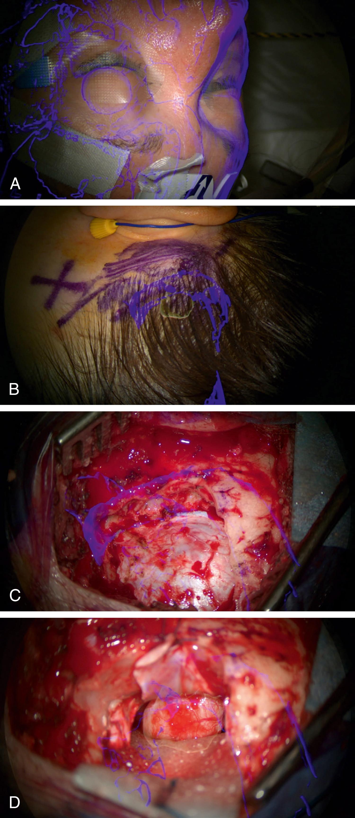 Figure 30.4, Augmented microscope views in a patient undergoing a left retrosigmoid approach for resection of a vestibular schwannoma.