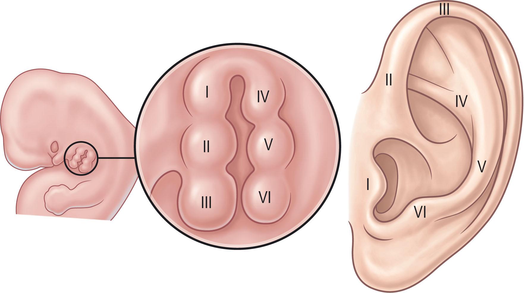 Figure 4.1, Development of the auricle in a 5-week human embryo: I–VI, elevations (hillocks) on the mandibular and hyoid arches.