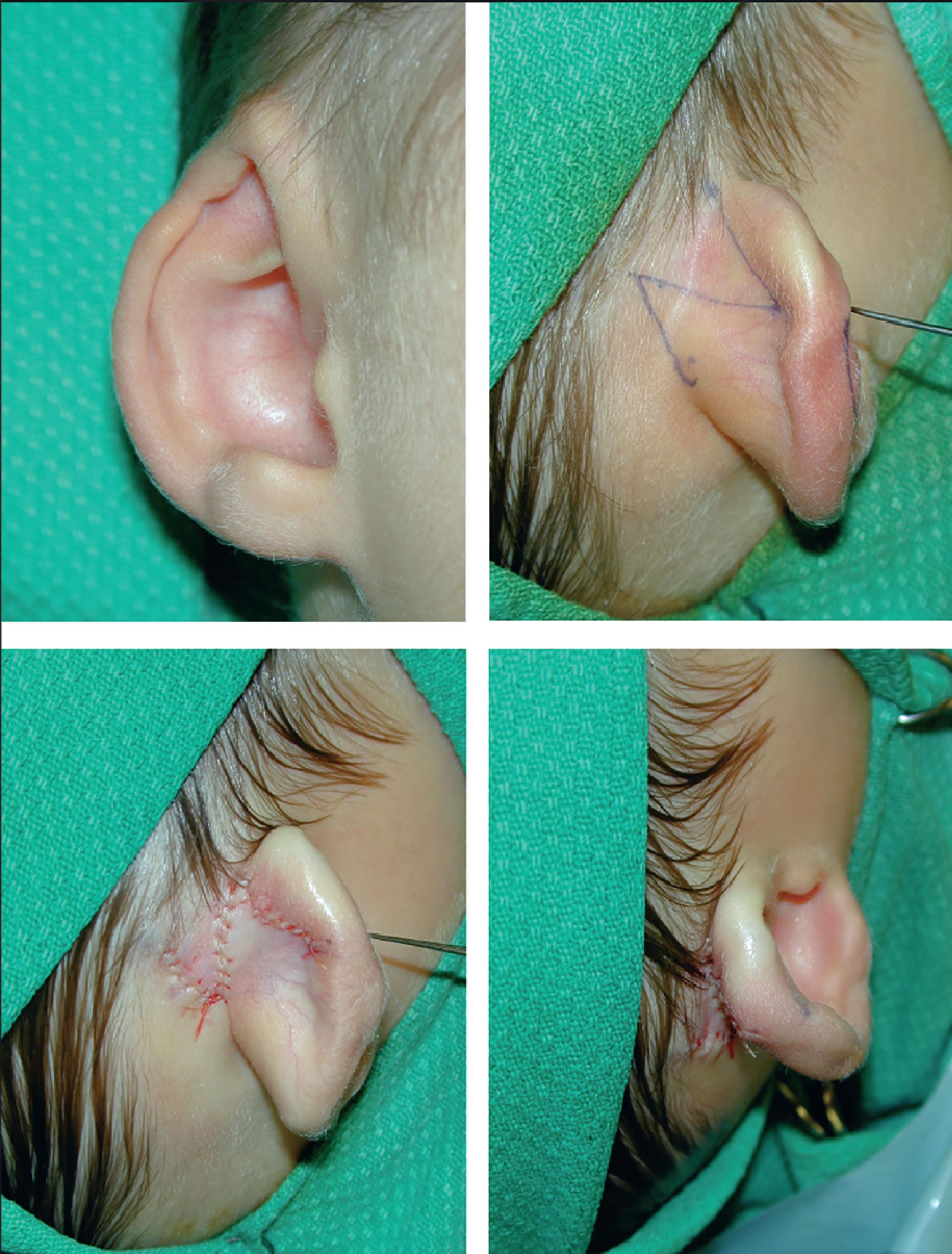 Figure 4.8, Illustration of cryptotia correction where the superior third cartilage is elevated using a Z-plasty to reconstitute the auriculocephalic fold. (Top left) Right ear cryptotia; (top right) Z-plasty markings within the planned fold; (bottom left) after transposition of the Z-plasty skin flaps; and (bottom right) presence of superior third projection and auriculocephalic fold after Z-plasty flap transposition.