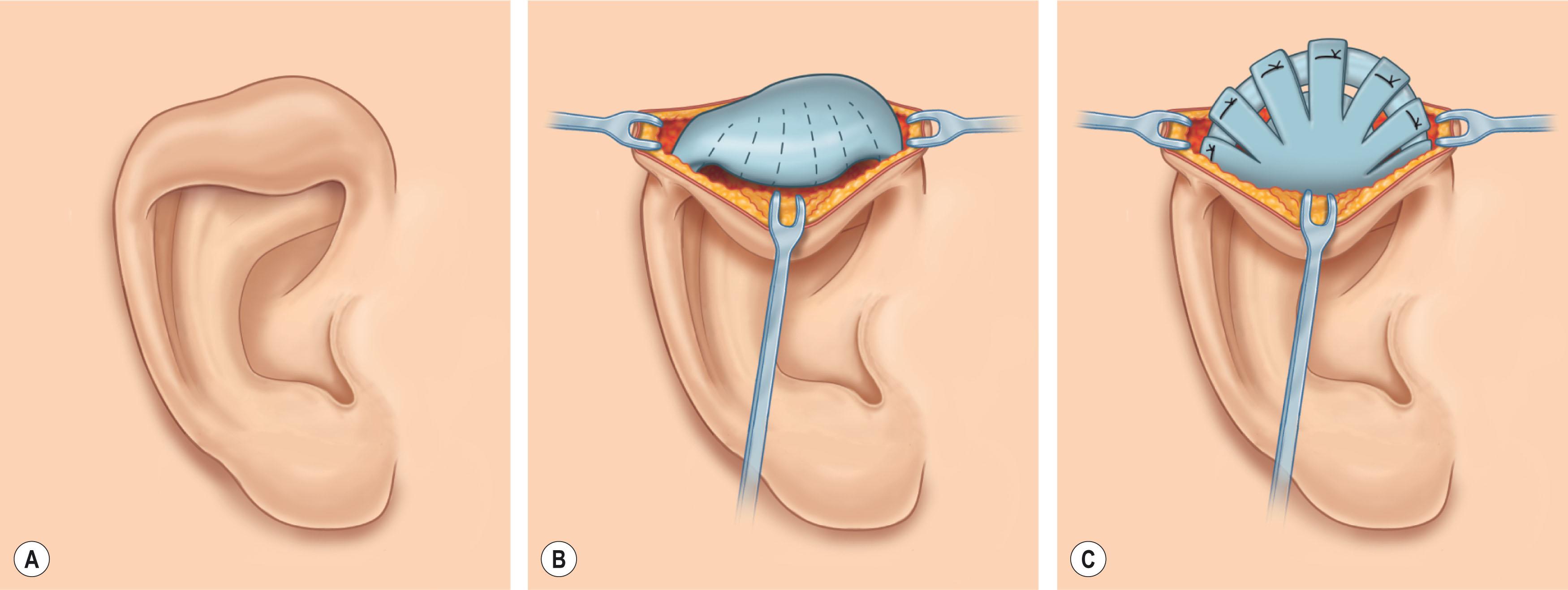Figure 4.10, The Musgrave technique of correcting type IIA constricted ear. (A) Preoperative view of the deformity. (B) The folded cartilage is exposed through posterior incision. (C) Cartilage fingers are elevated and fixed to a strut of conchal cartilage.