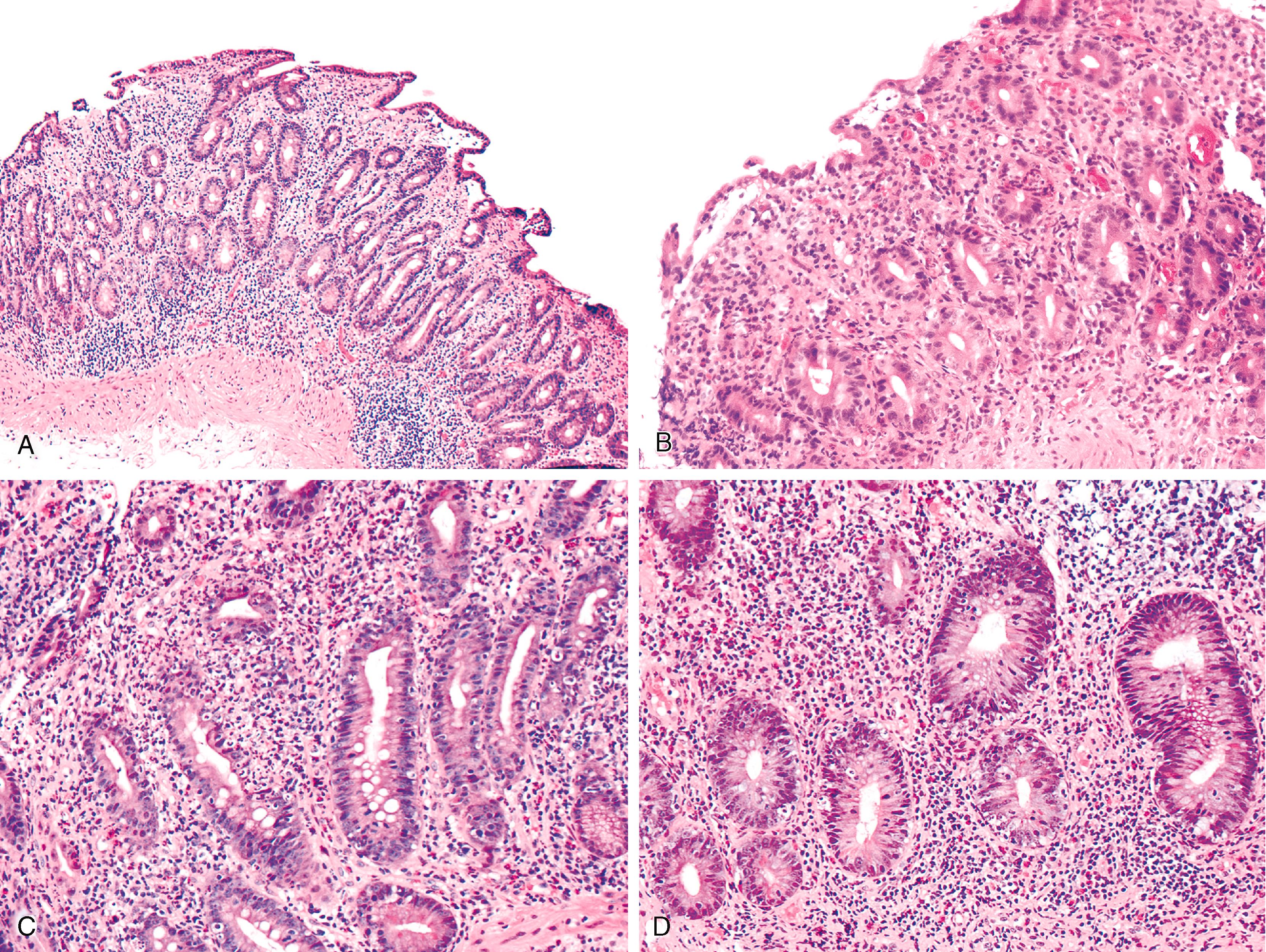 FIGURE 6.1, Histopathological features of autoimmune enteropathy involving the duodenum.