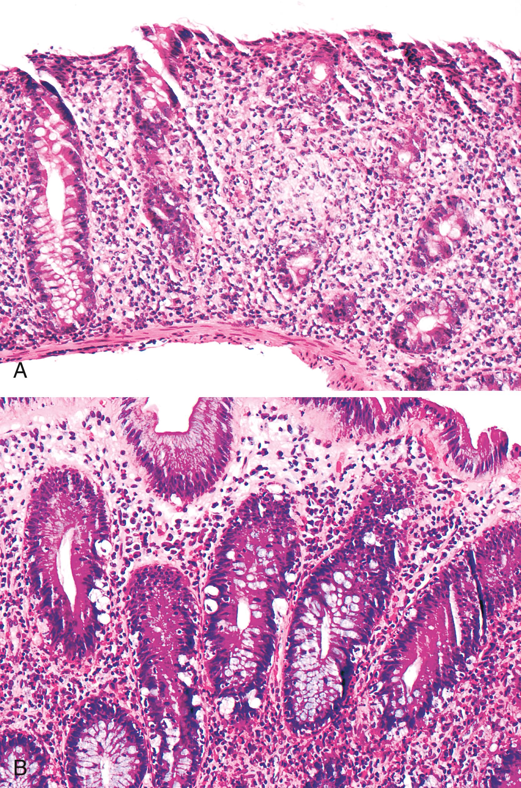 FIGURE 6.3, Autoimmune enteropathy involving the colon.