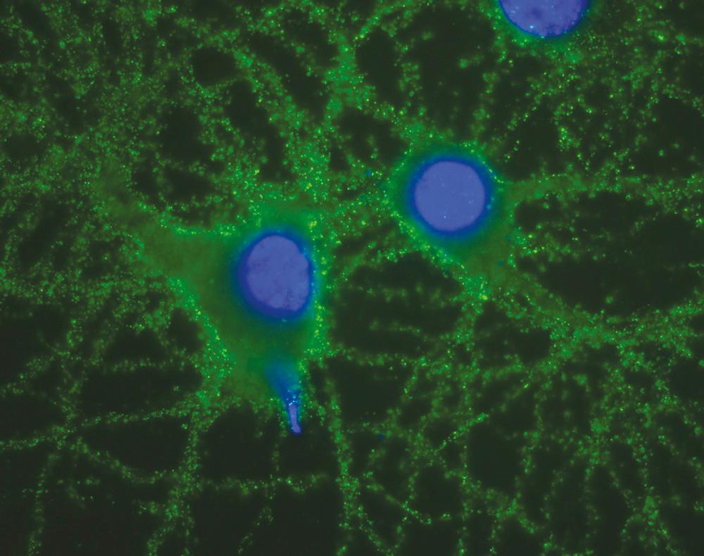 Fig. 82.1, Antibodies to GluN1 subunit of the NMDA receptor in a patient with anti-NMDAR encephalitis. Live rat hippocampal neurons incubated with the patient’s CSF are immunolabeled with antibodies against cell surface antigens; subsequent characterization demonstrated that the antigen is the GluN1 subunit of the NMDA receptor. CSF , Cerebrospinal fluid; NMDA , N -methyl- d -aspartate; NMDAR , N -methyl- d -aspartate receptor.